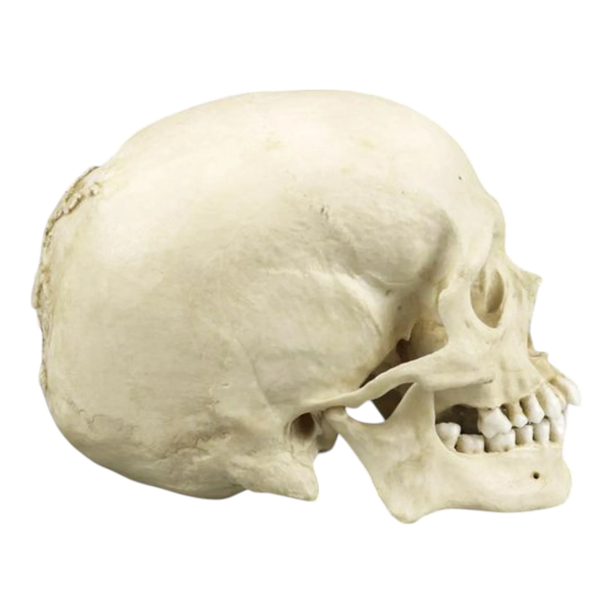 Replica Human Skull with Syphilis - Image 2