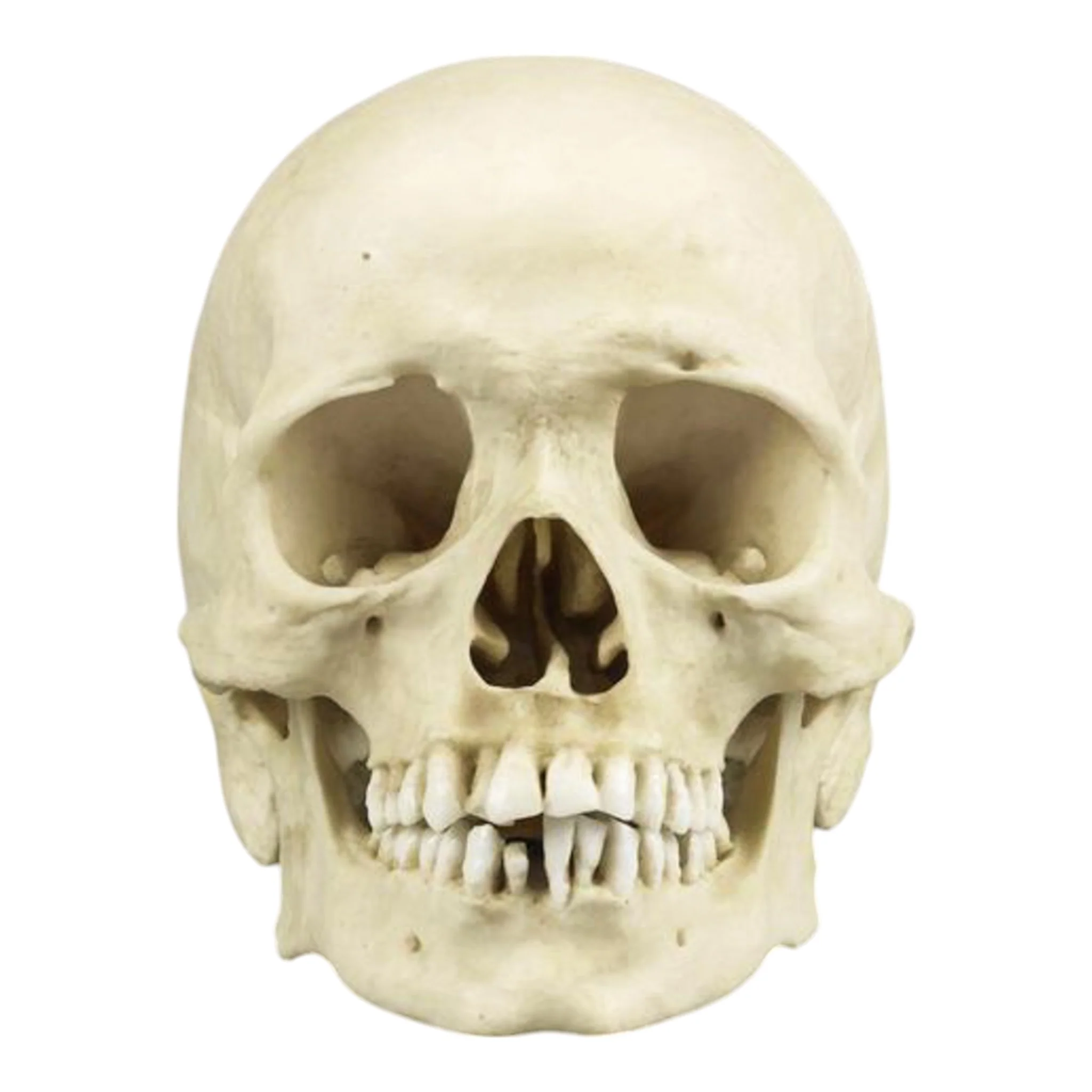 Replica Human Skull with Syphilis - Image 3