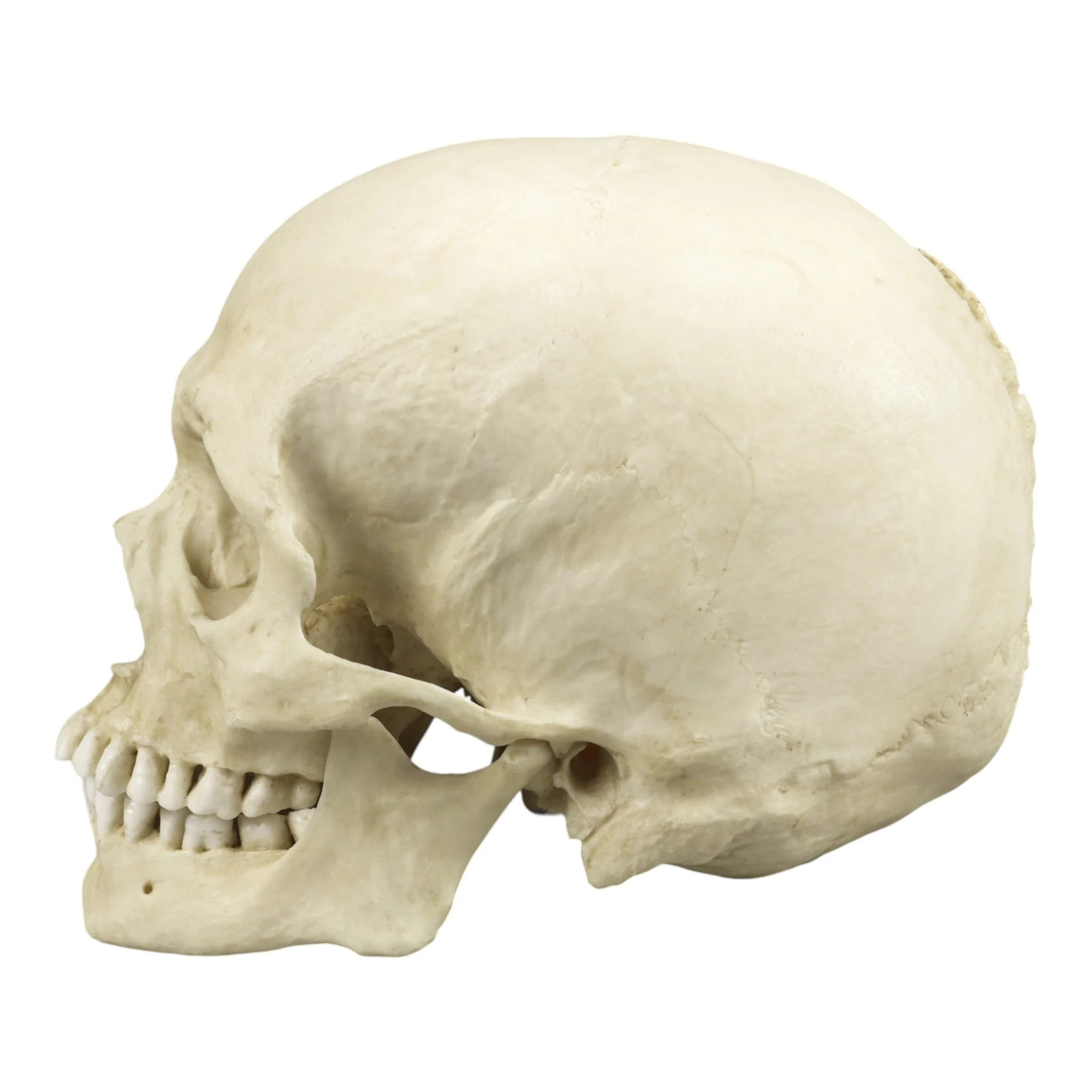 Replica Human Skull with Syphilis - Image 4