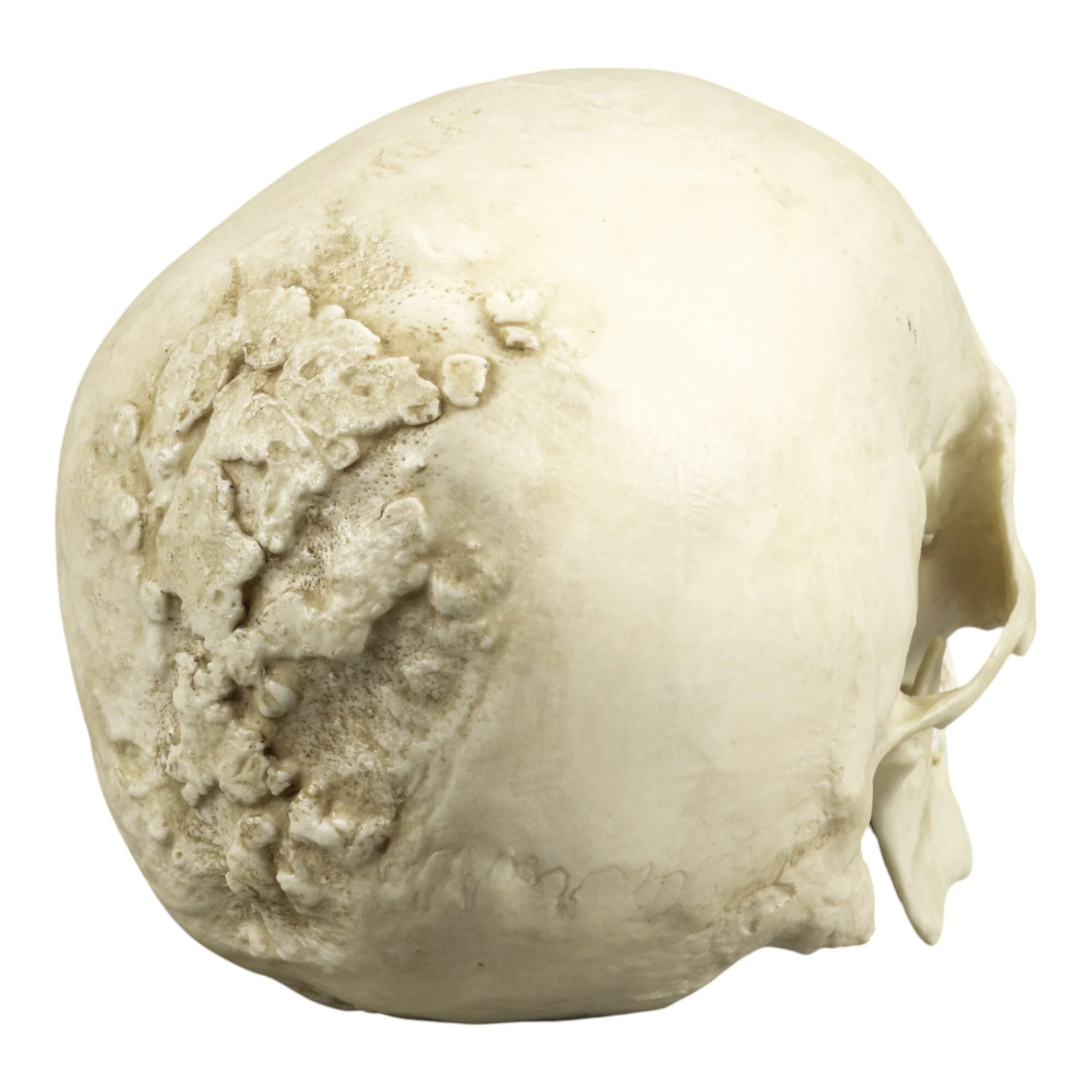 Replica Human Skull with Syphilis - Image 6