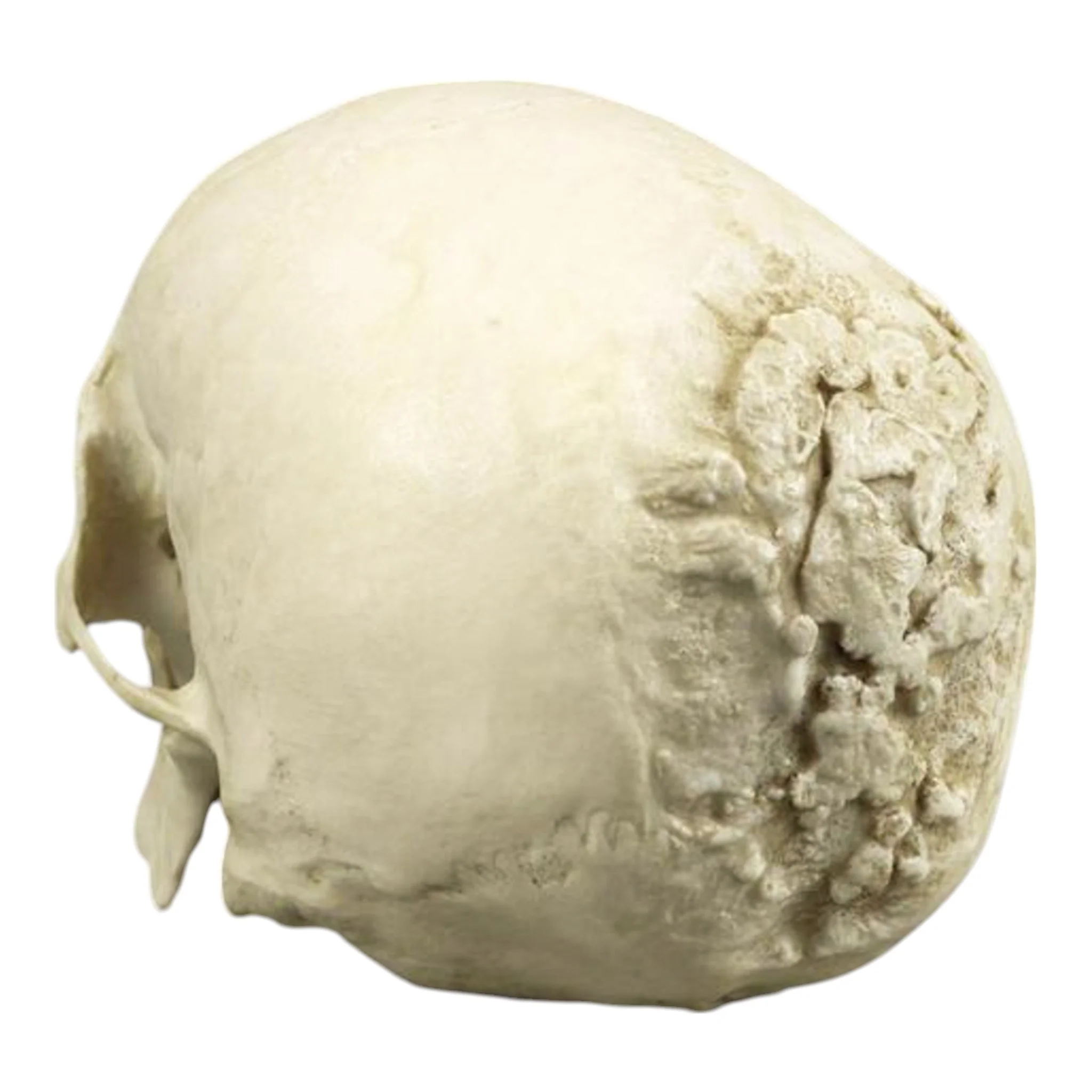 Replica Human Skull with Syphilis - Image 7