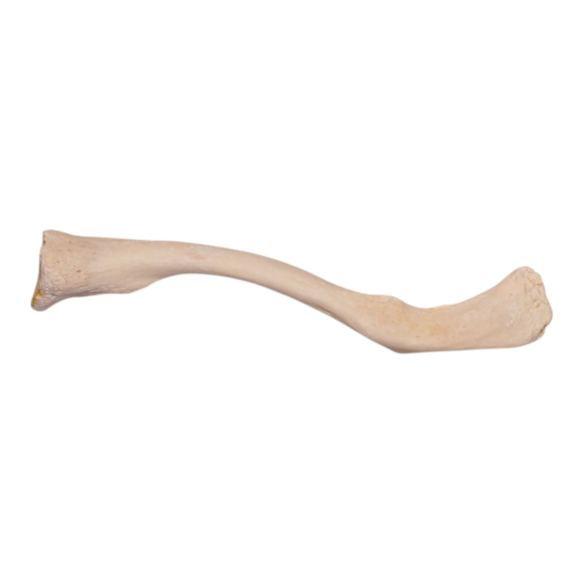 Real Human Clavicle - Pathology - Image 2