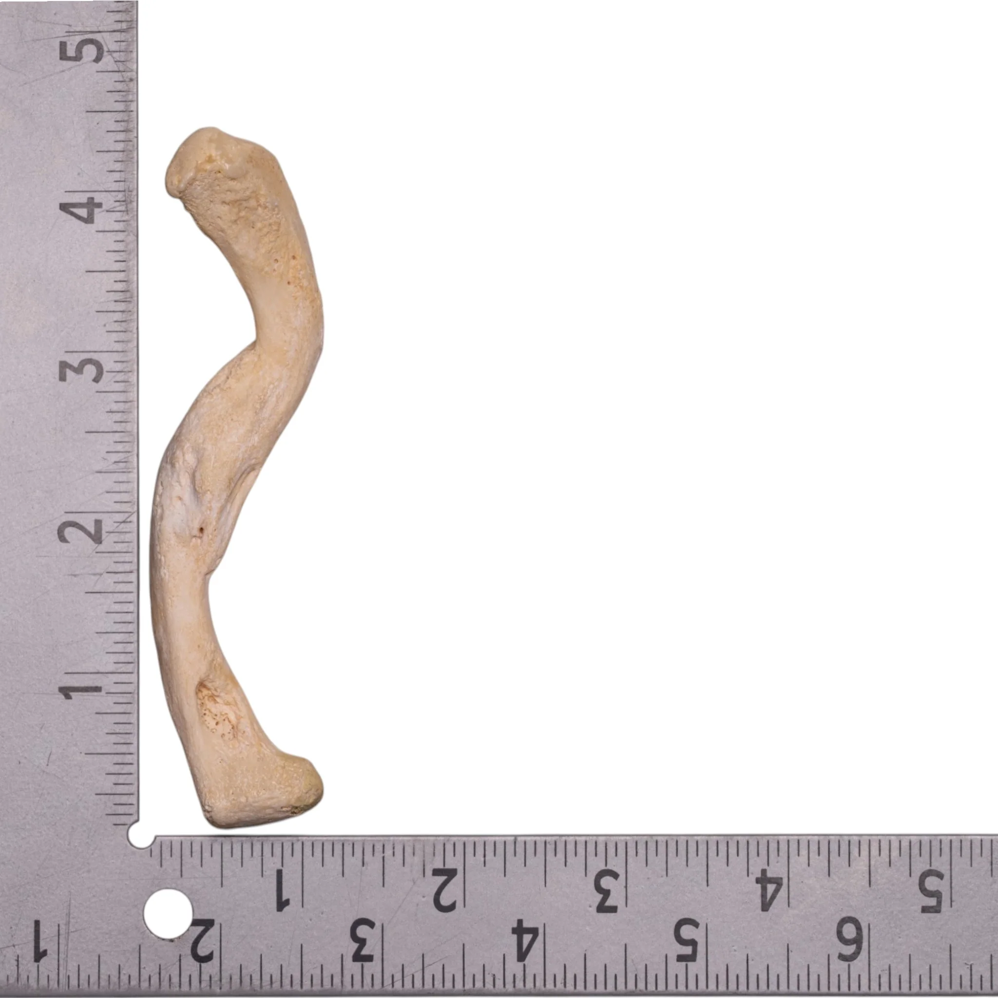 Real Human Clavicle - Pathology - Image 3