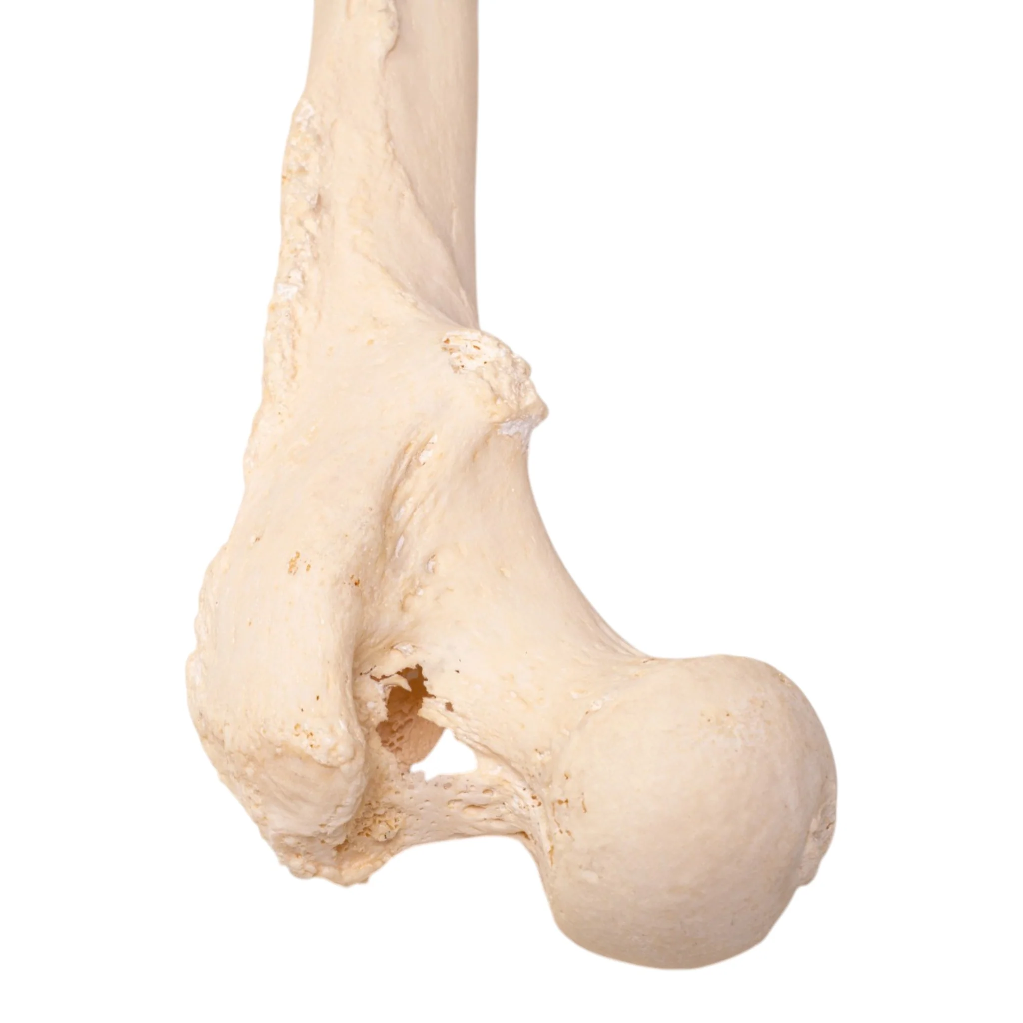 Real Human Femur - Pathology - Image 3