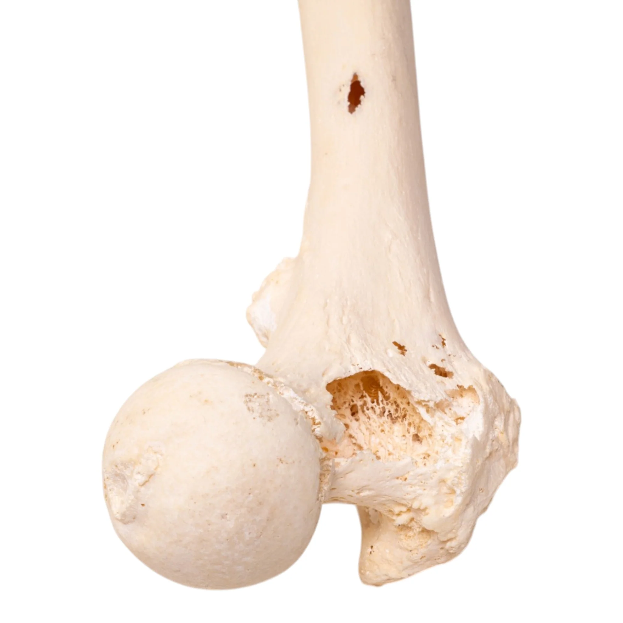 Real Human Femur - Pathology - Image 4