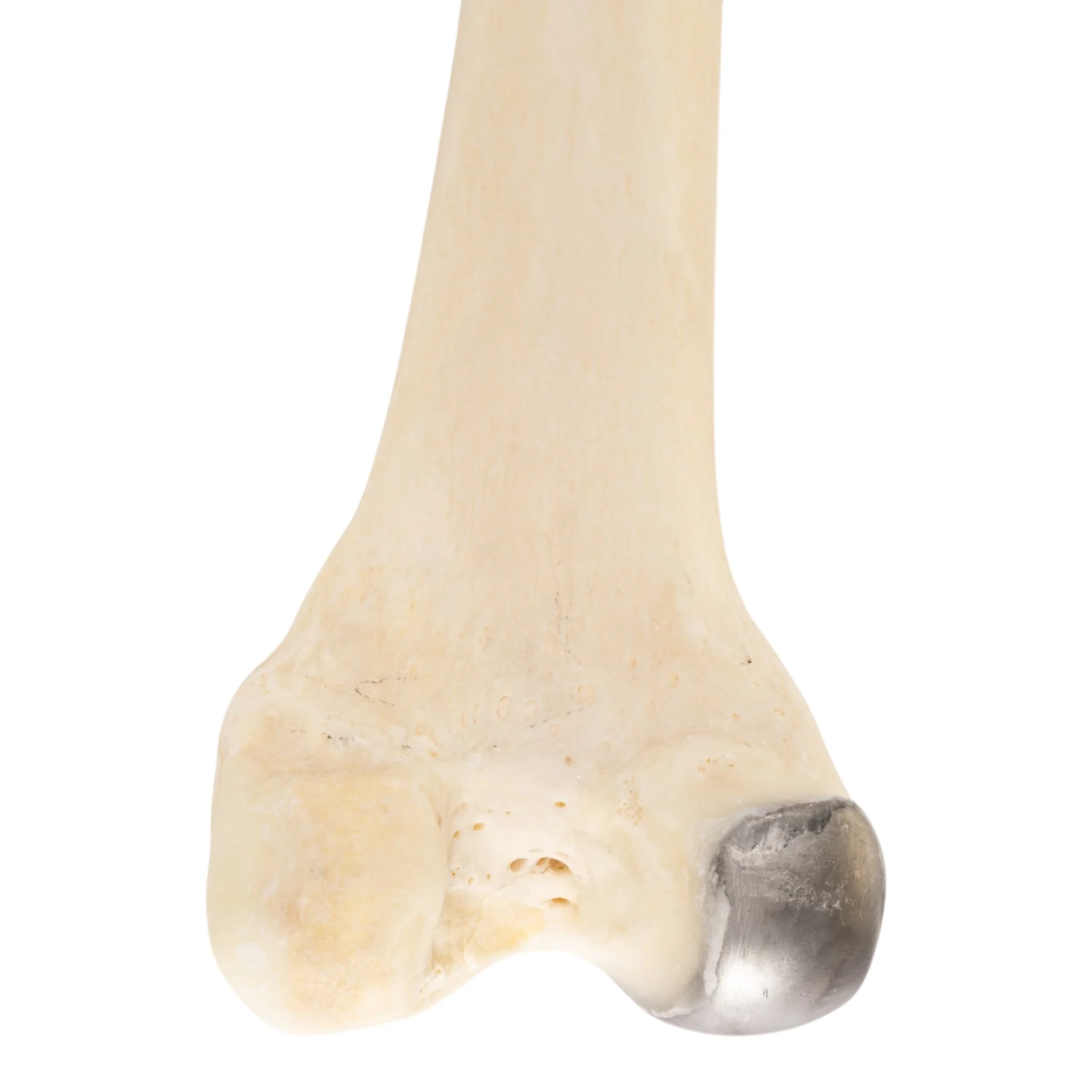 Real Human Femur - Pathology - Image 3