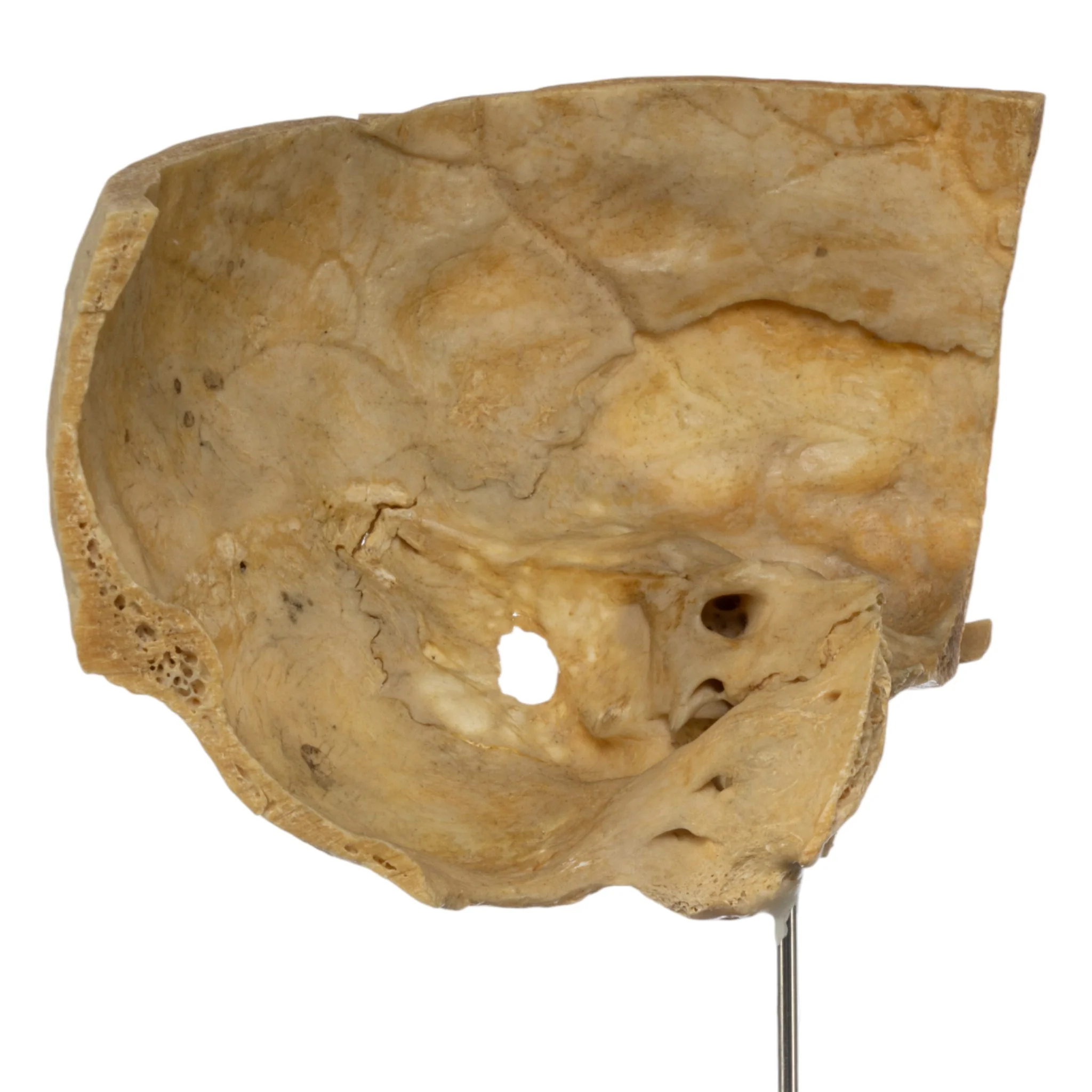 Real Human Partial Skull on Stand - Image 2