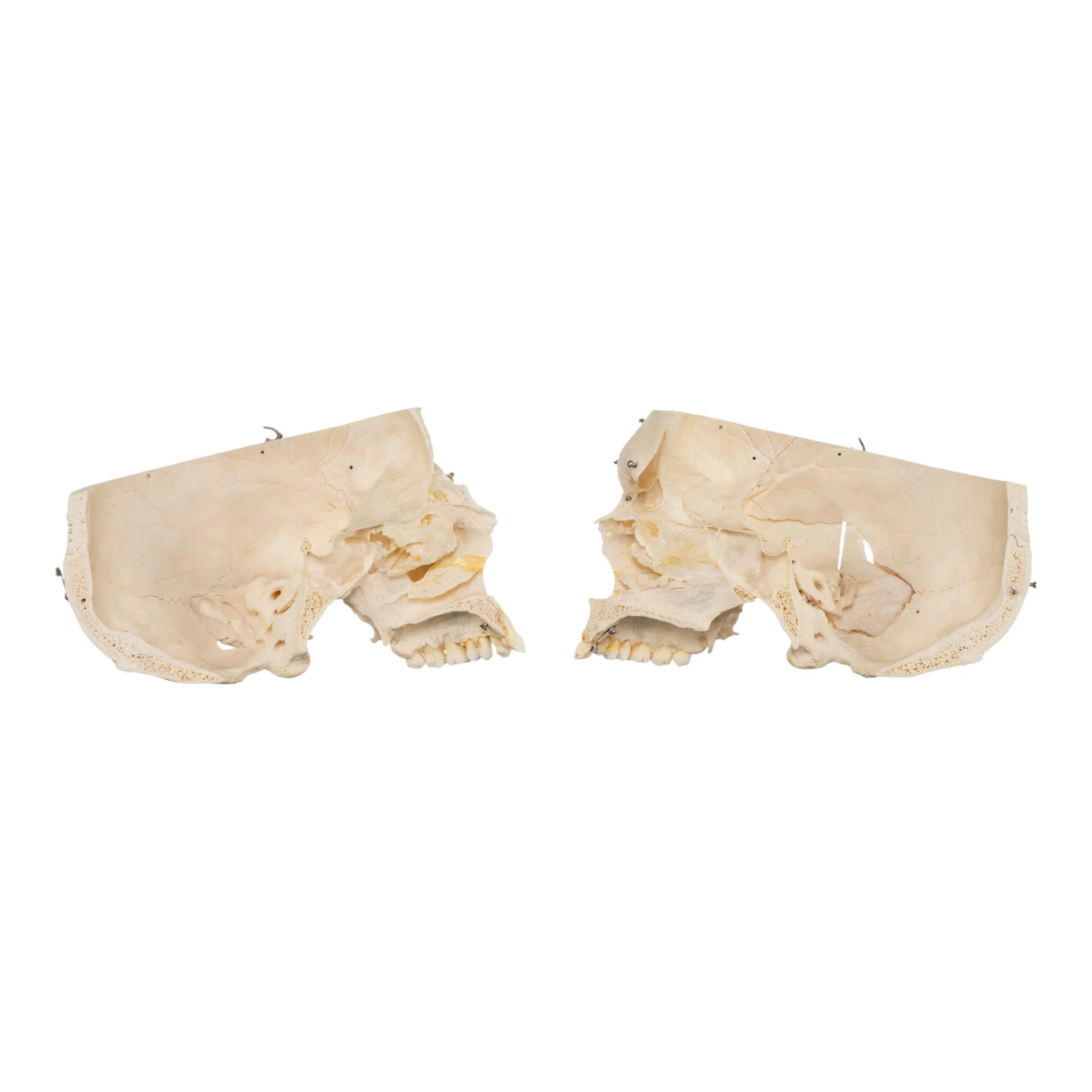 Real Human Skeleton - Disarticulated - Image 9