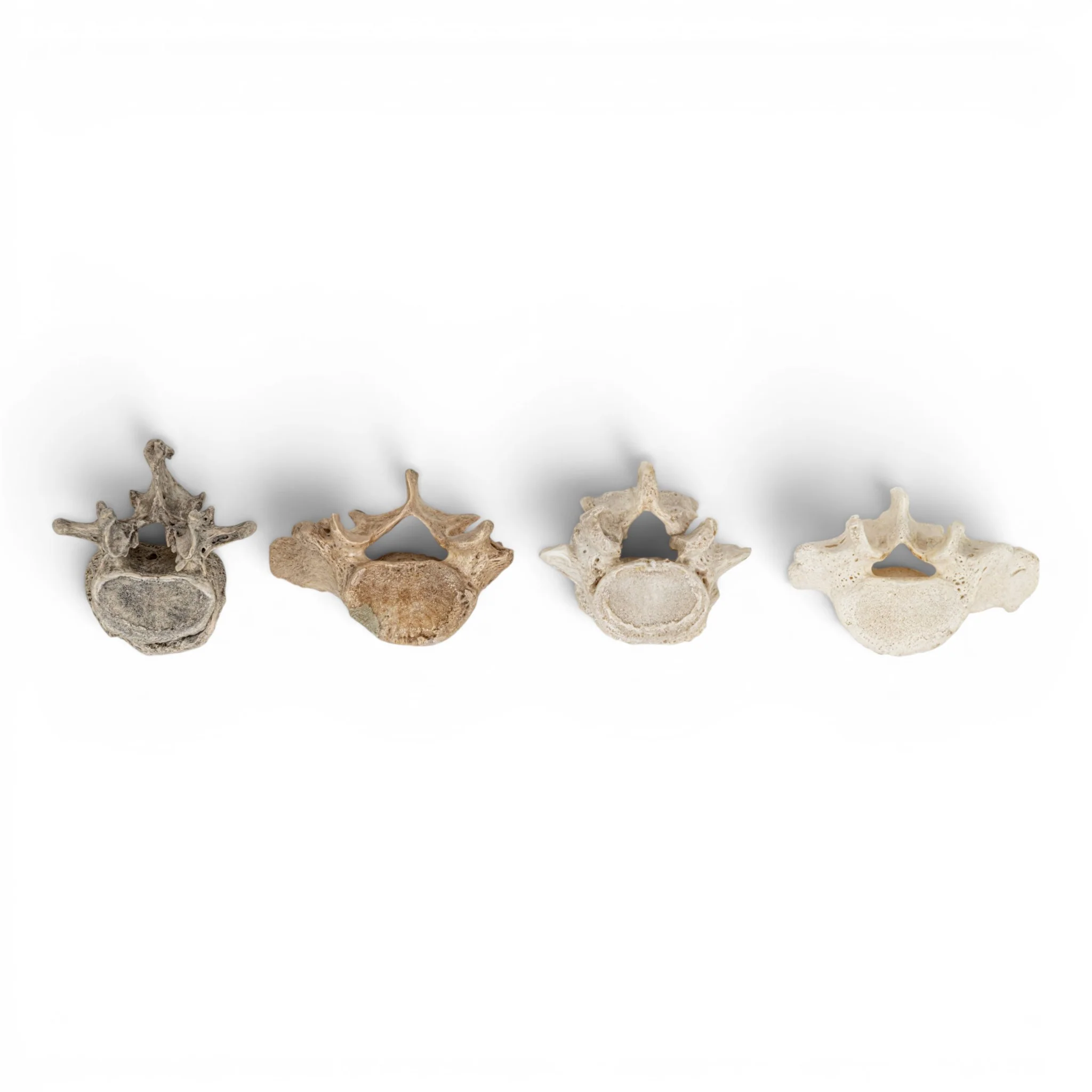 Real Human Lumbar Vertebrae Set - Pathology