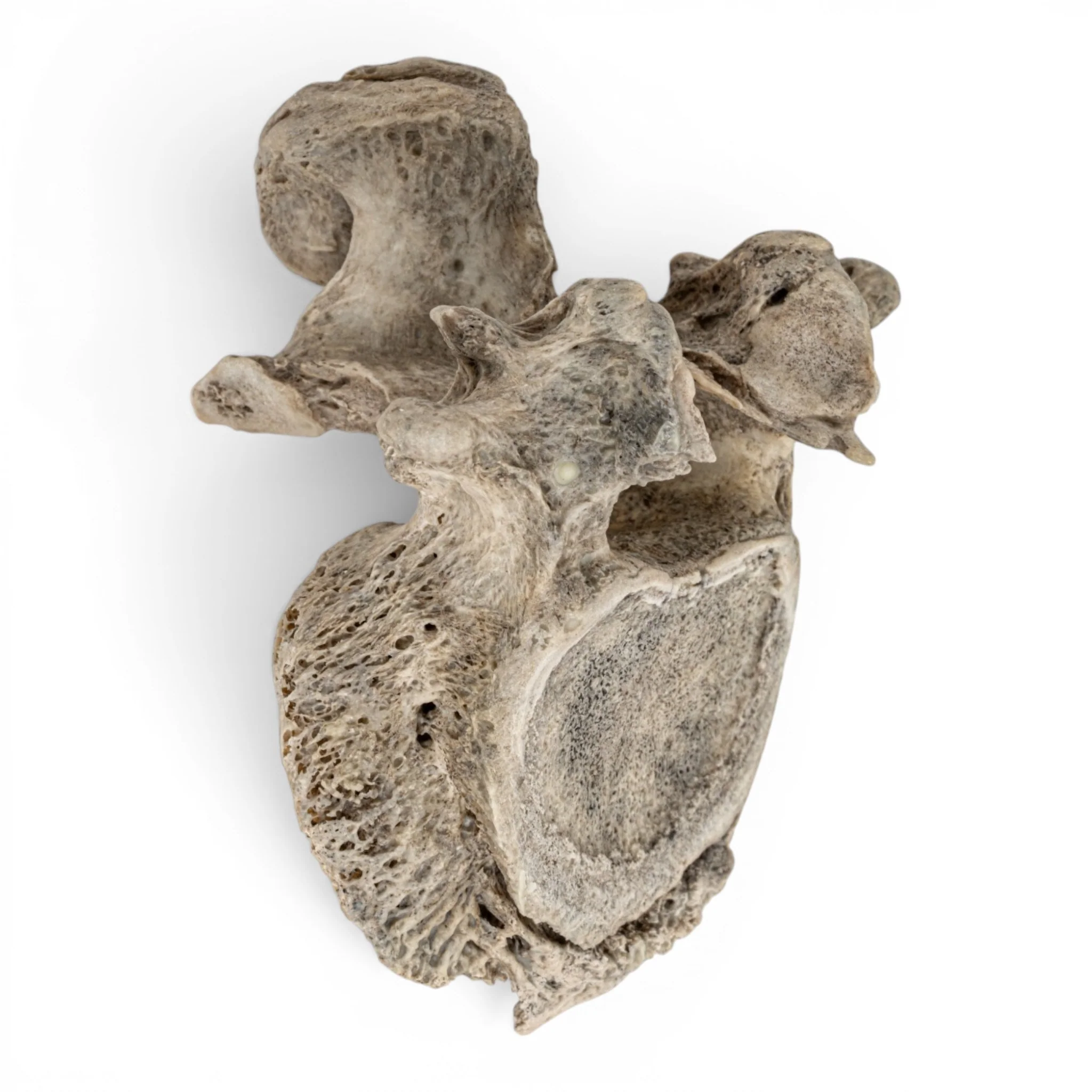 Real Human Lumbar Vertebrae Set - Pathology - Image 3