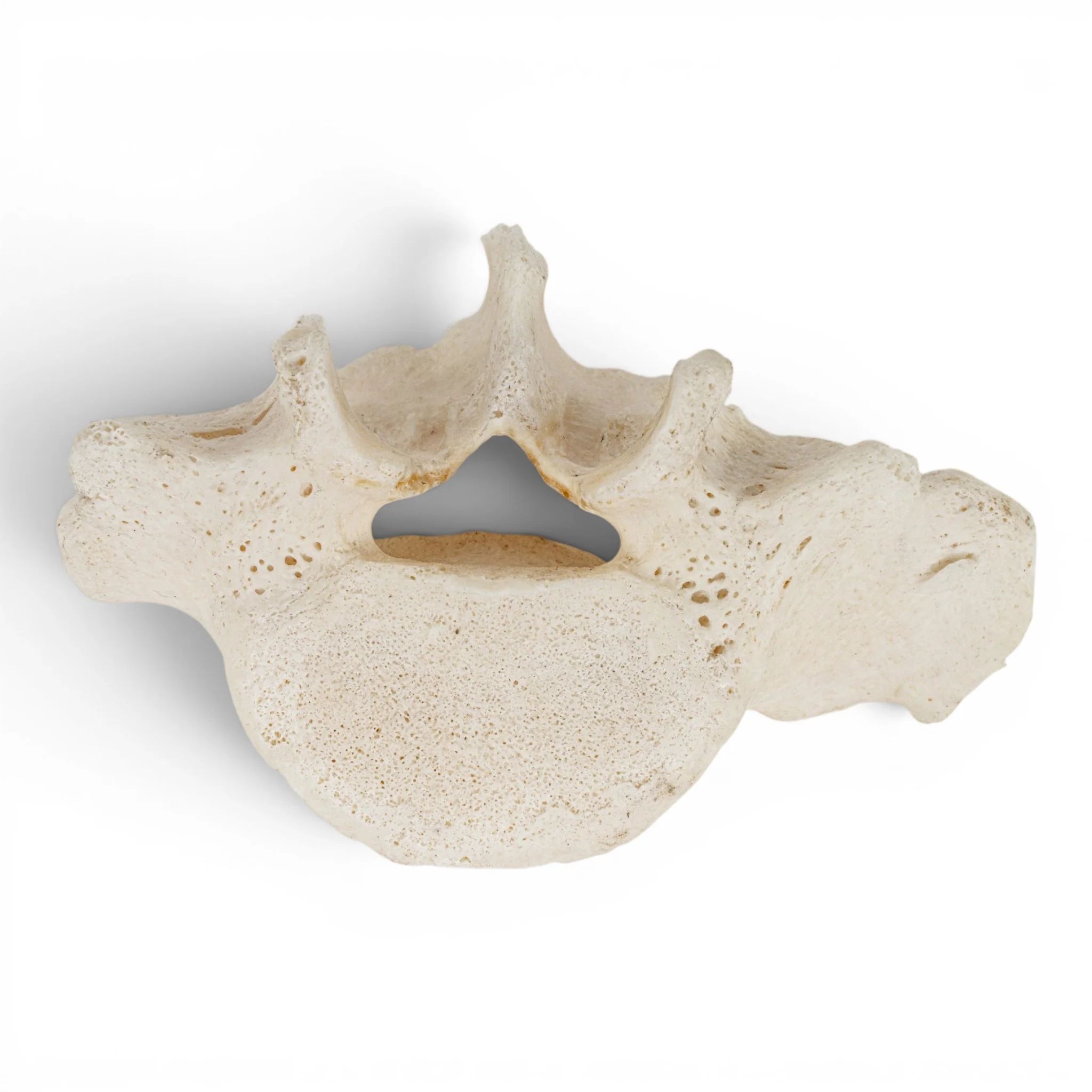 Real Human Lumbar Vertebrae Set - Pathology - Image 6