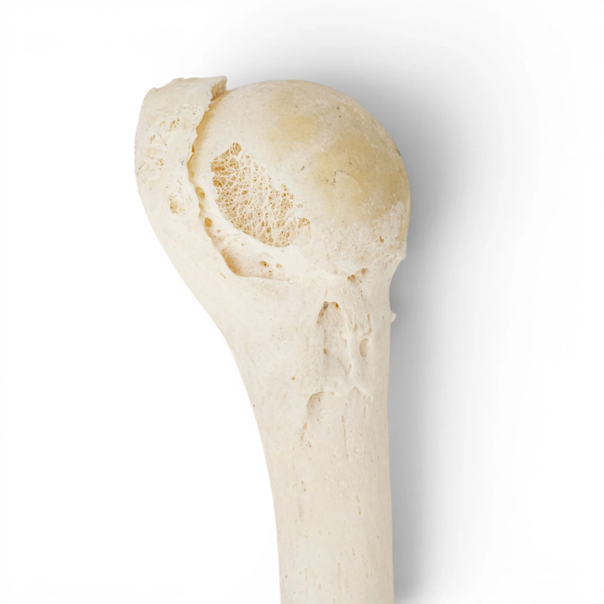 Real Human Humerus - Pathology - Image 4