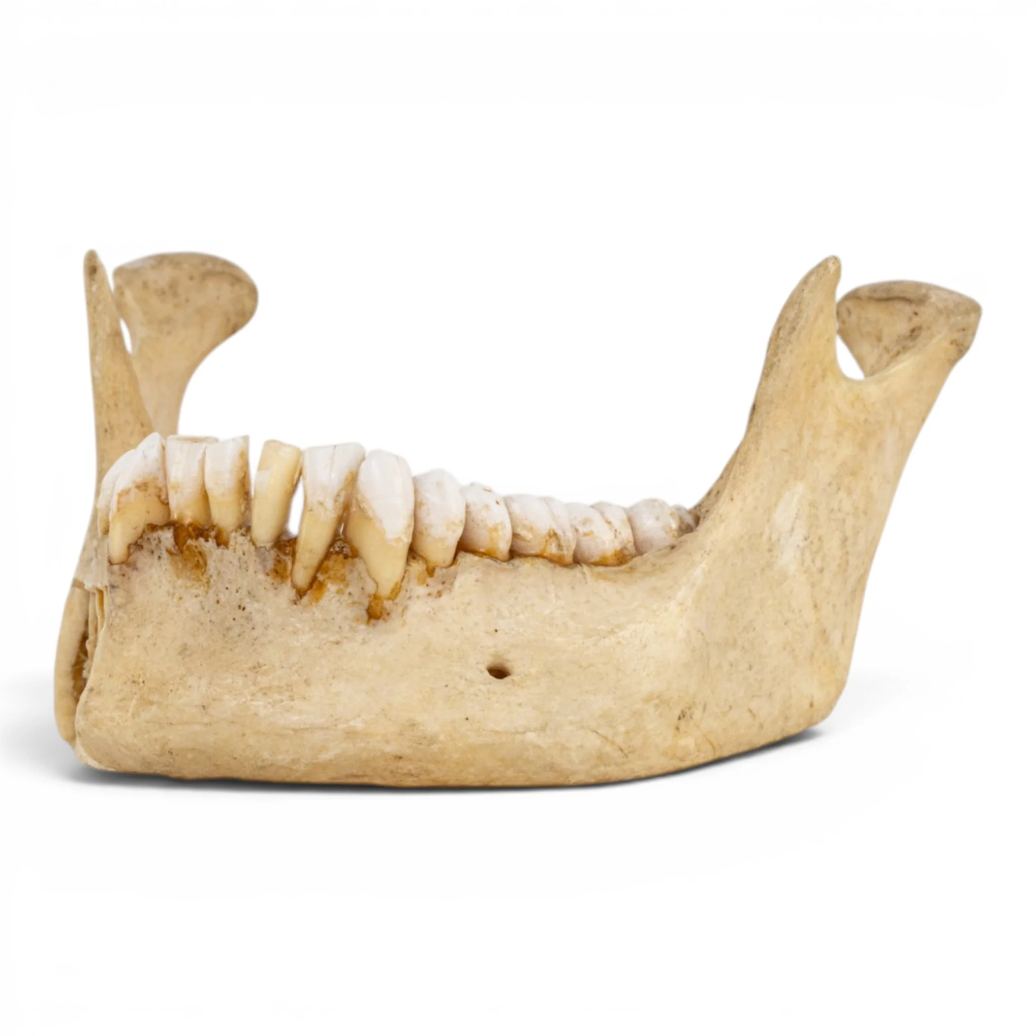 Real Human Mandible - Dissected