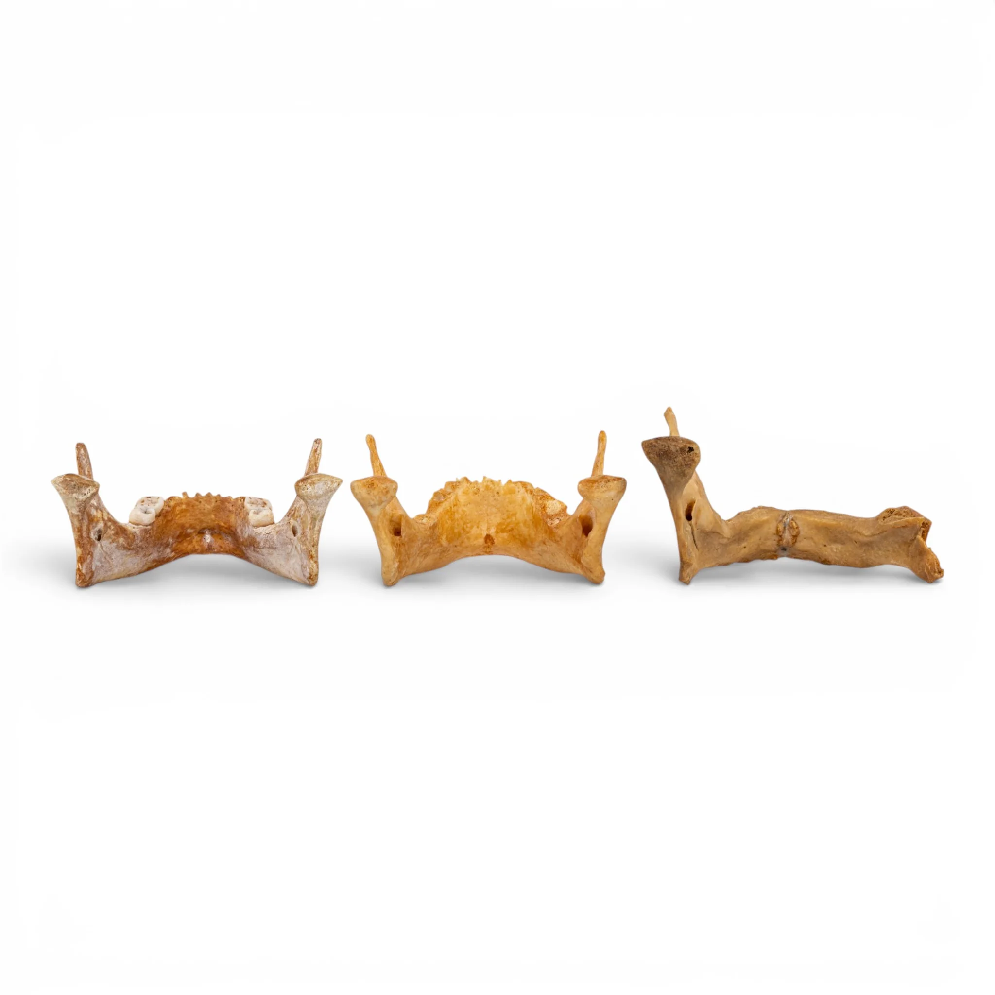 Real Human Mandible - Pathology - Set of 3 - Image 5