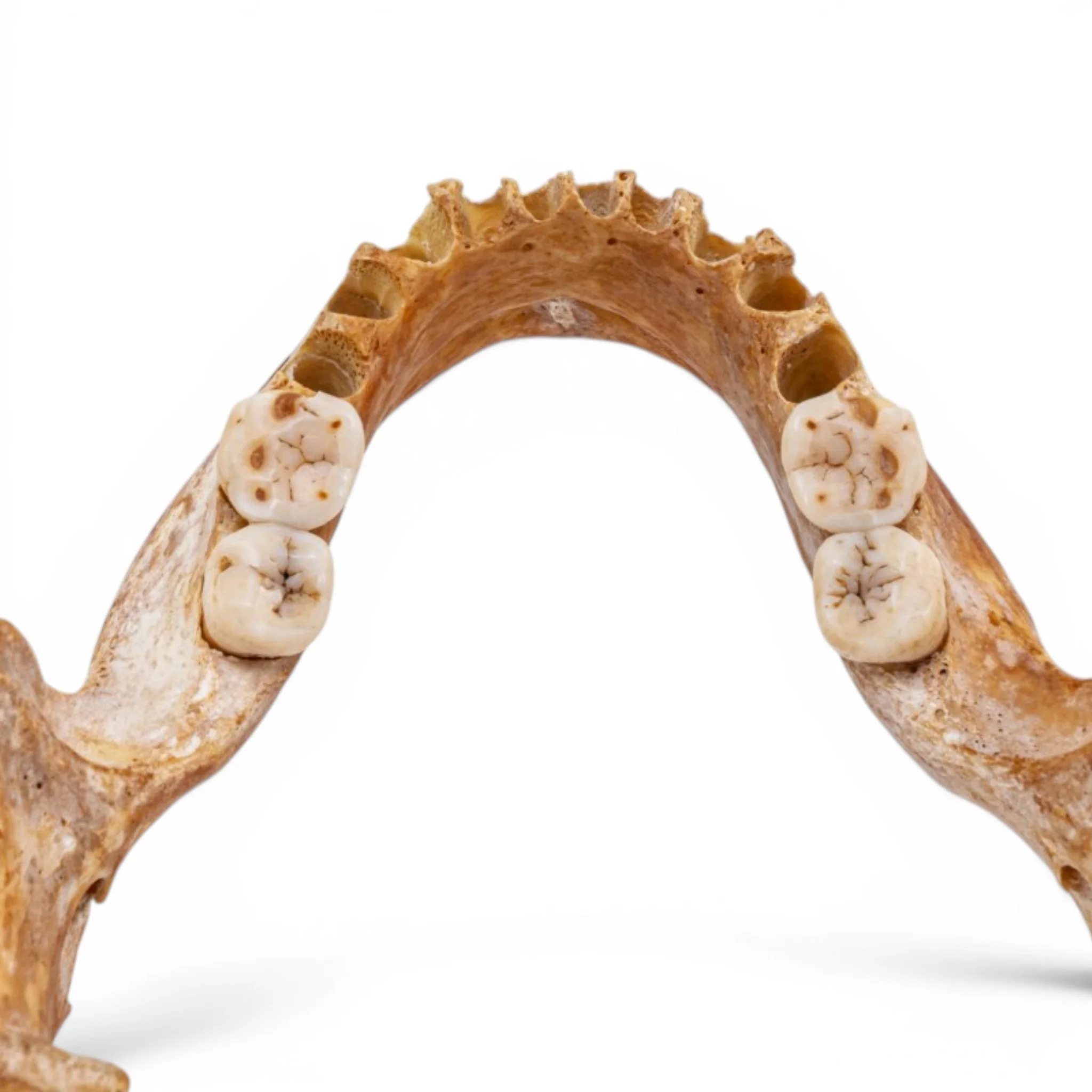 Real Human Mandible - Pathology - Set of 3 - Image 6