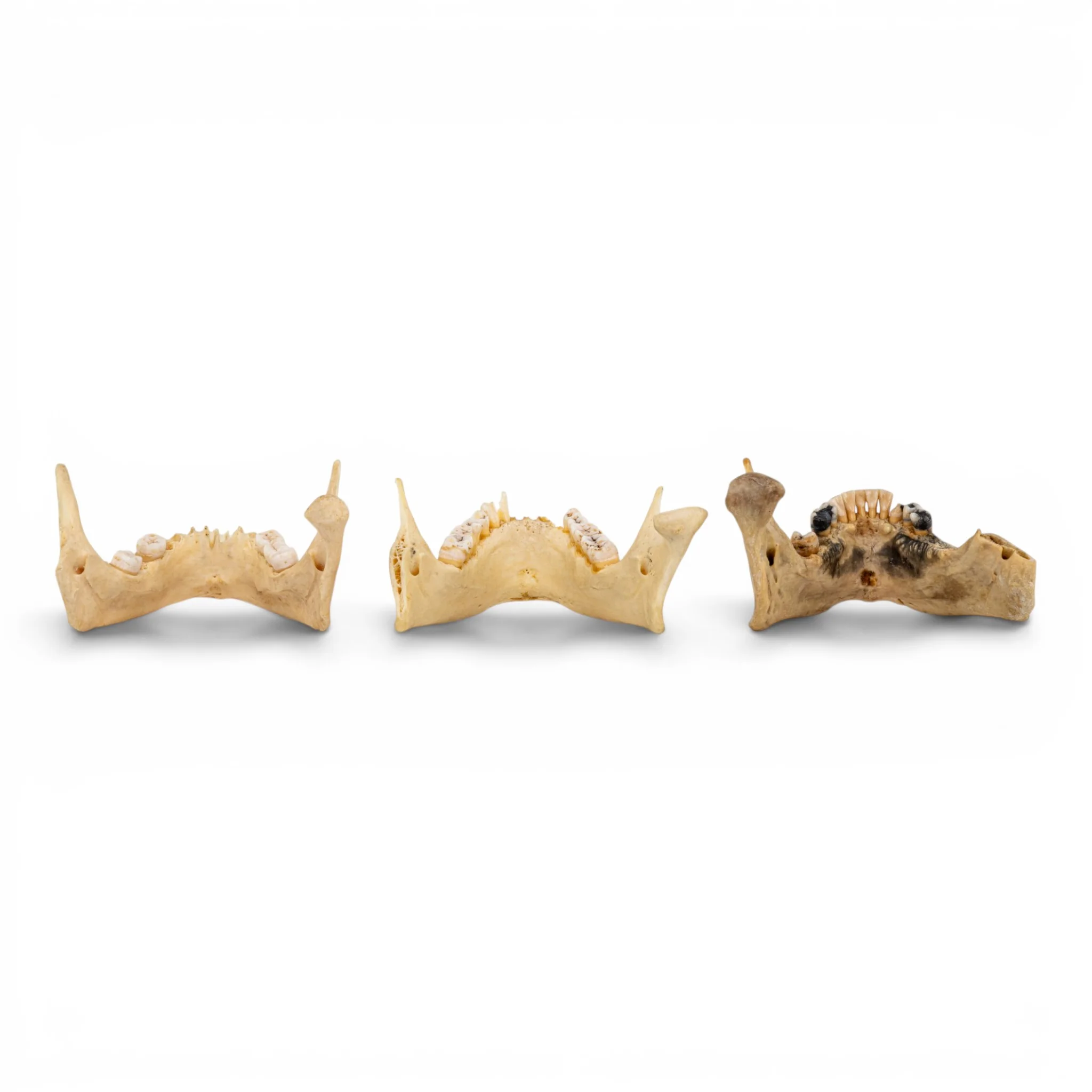 Real Human Mandible - Pathology - Set of 3 - Image 5