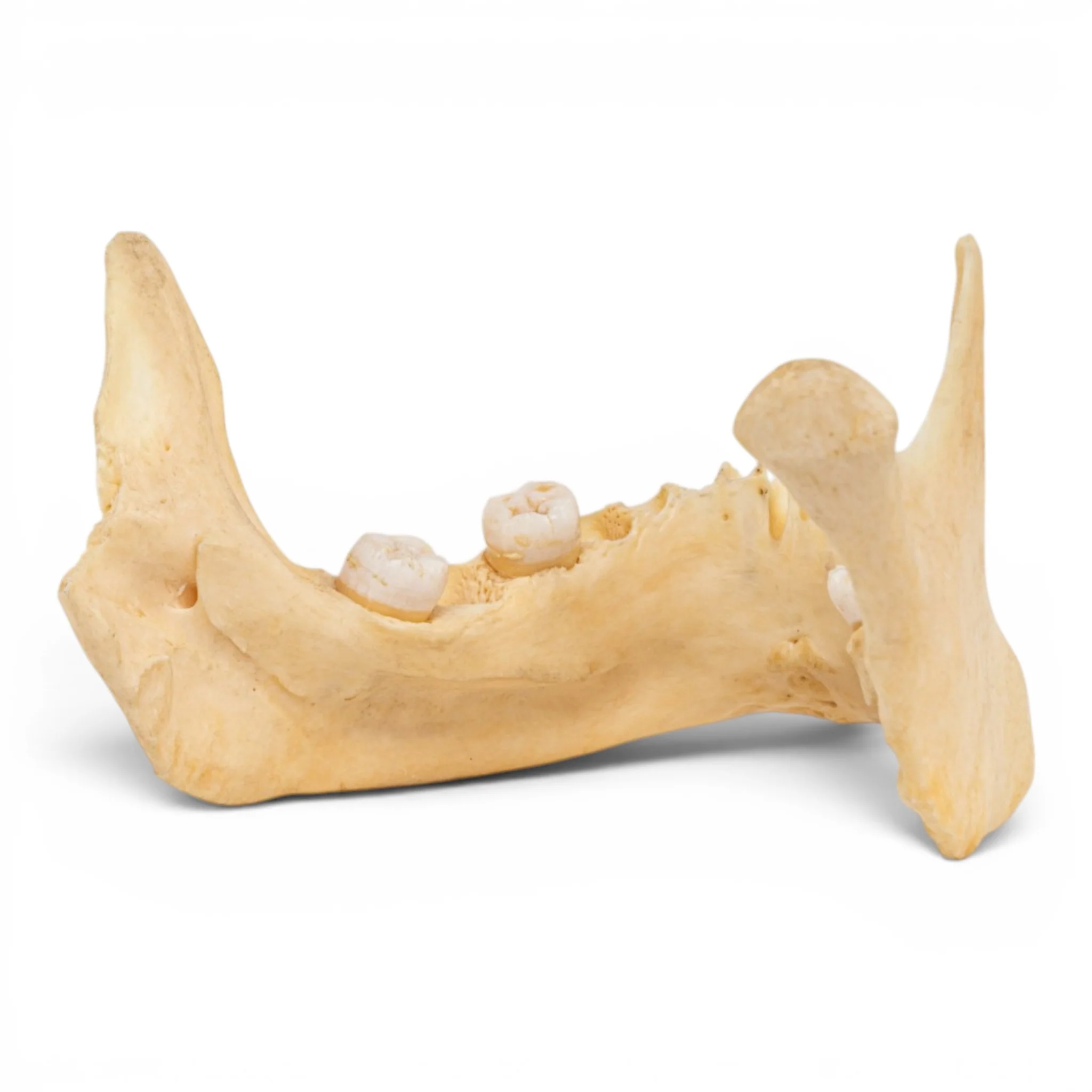 Real Human Mandible - Pathology - Set of 3 - Image 6