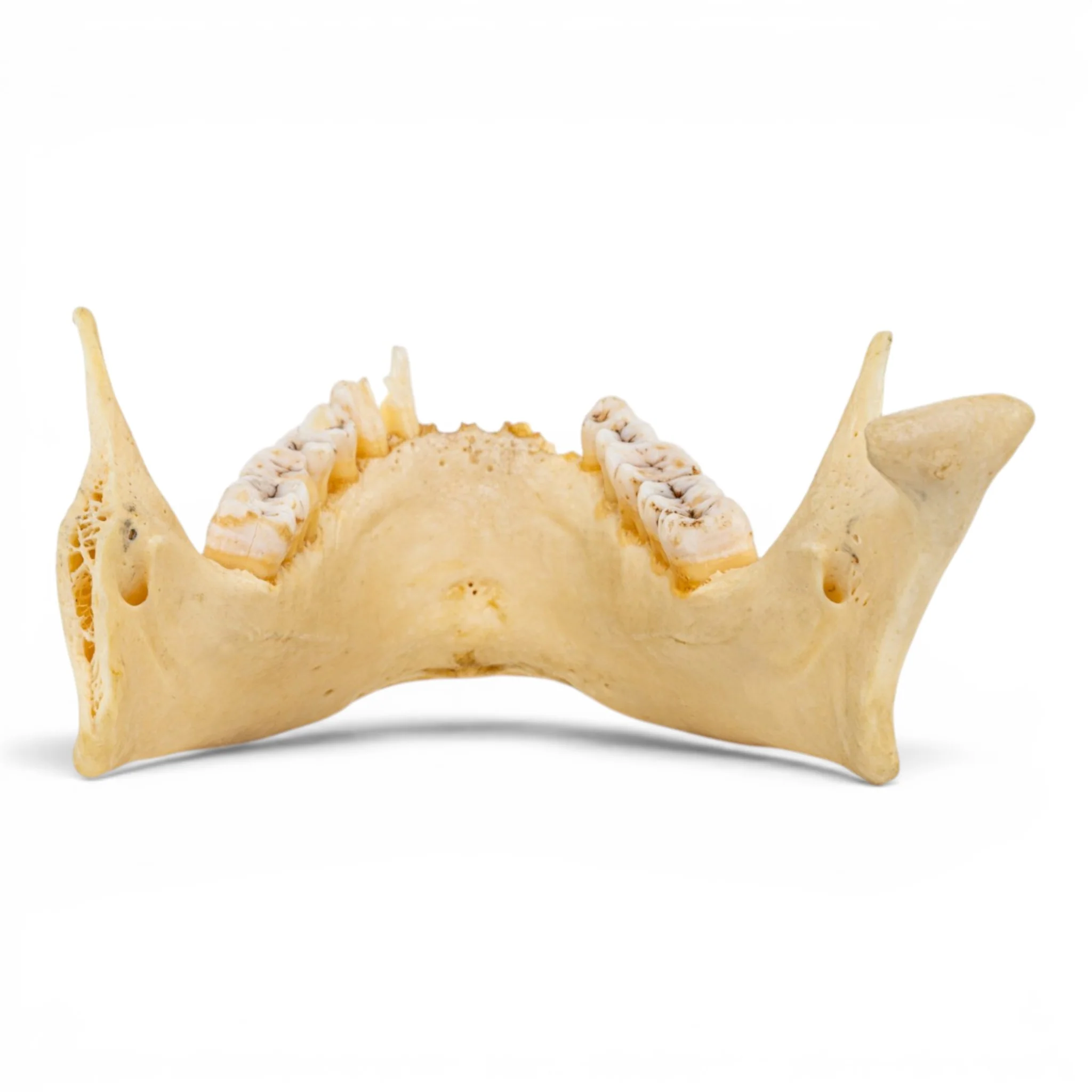 Real Human Mandible - Pathology - Set of 3 - Image 7