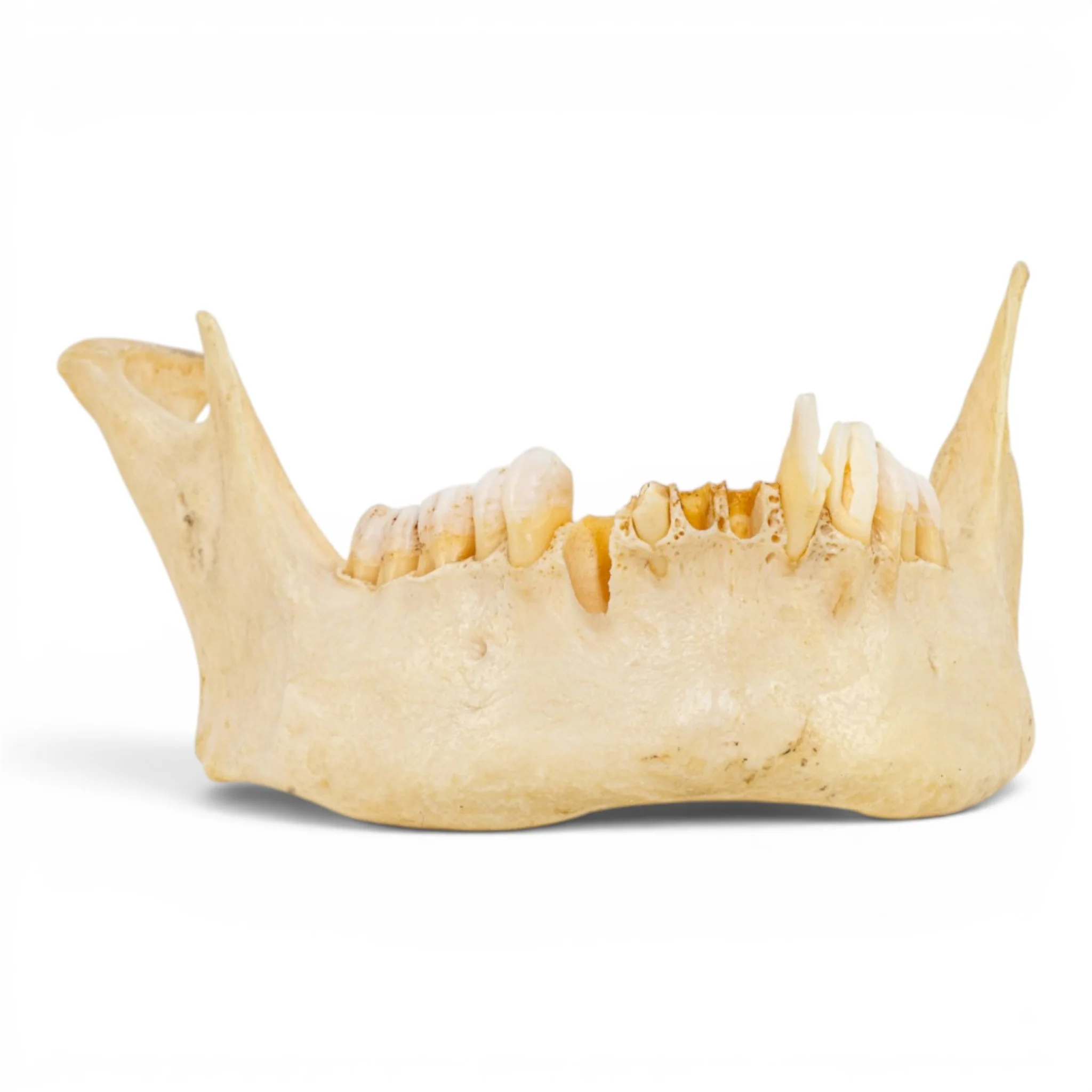 Real Human Mandible - Pathology - Set of 3 - Image 8