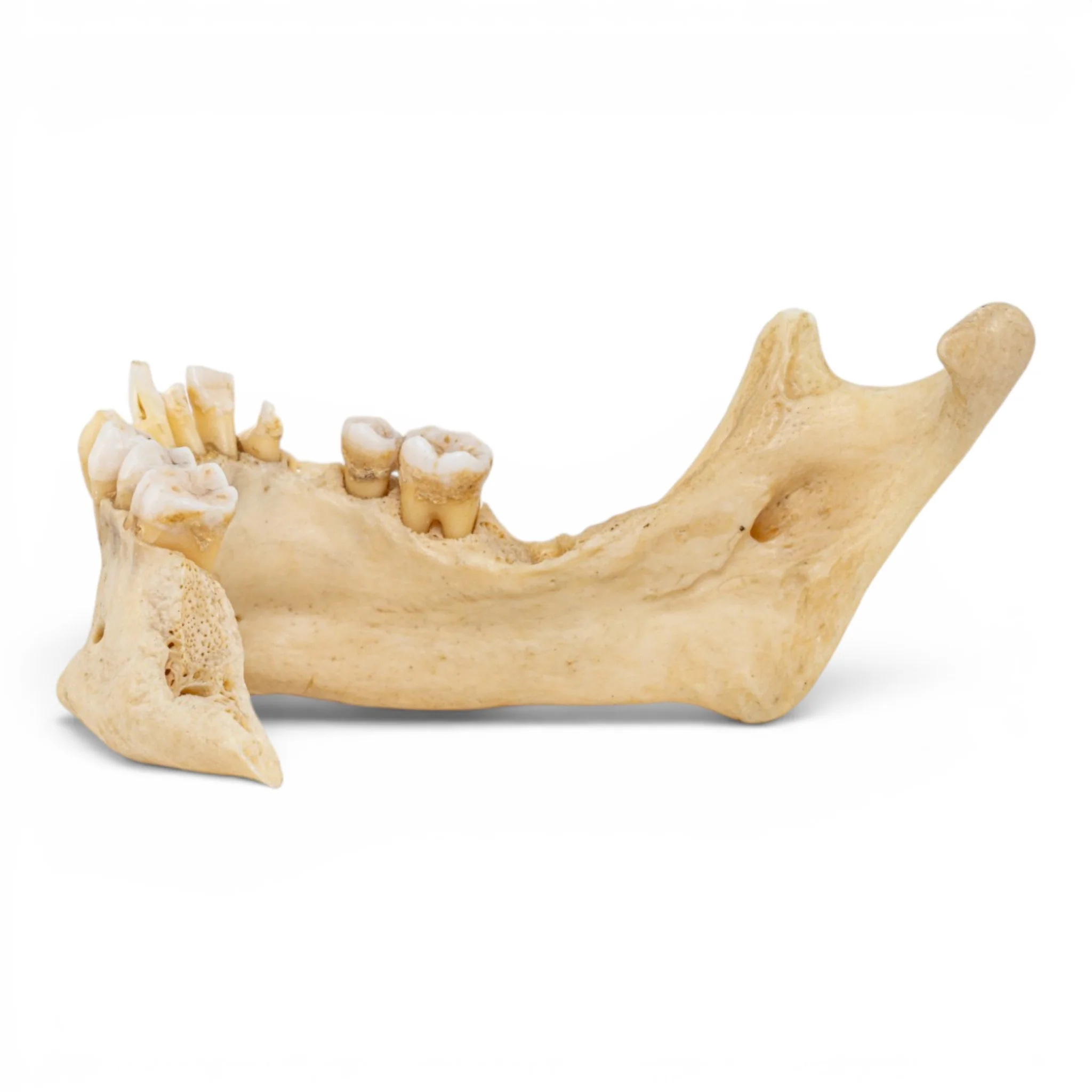 Real Human Mandible - Pathology - Set Of 3 - Image 6