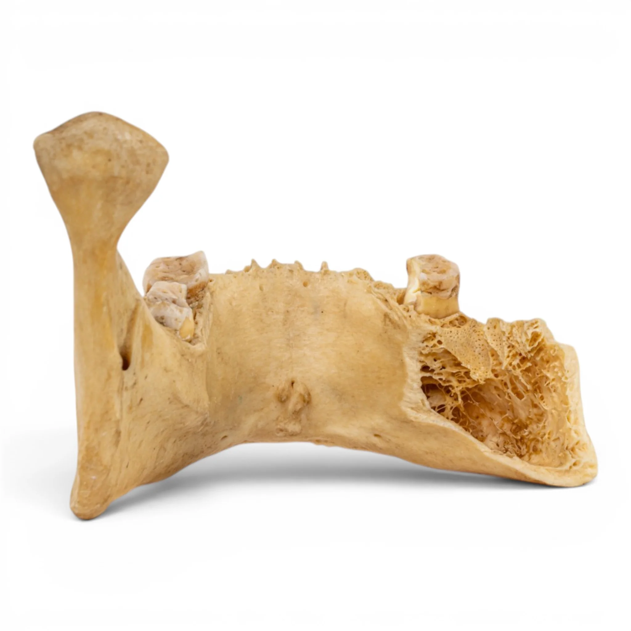 Real Human Mandible - Pathology - Set Of 3 - Image 8