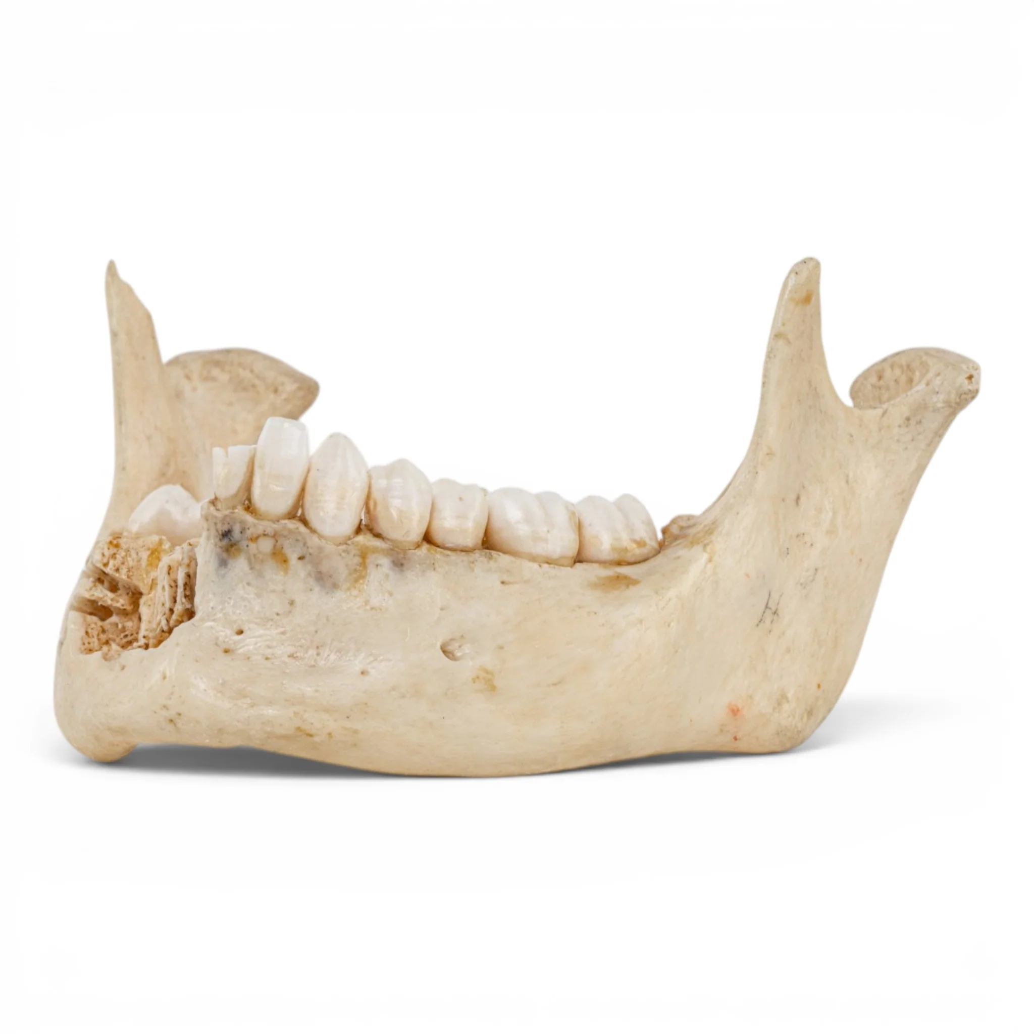 Real Human Mandible - Dissected