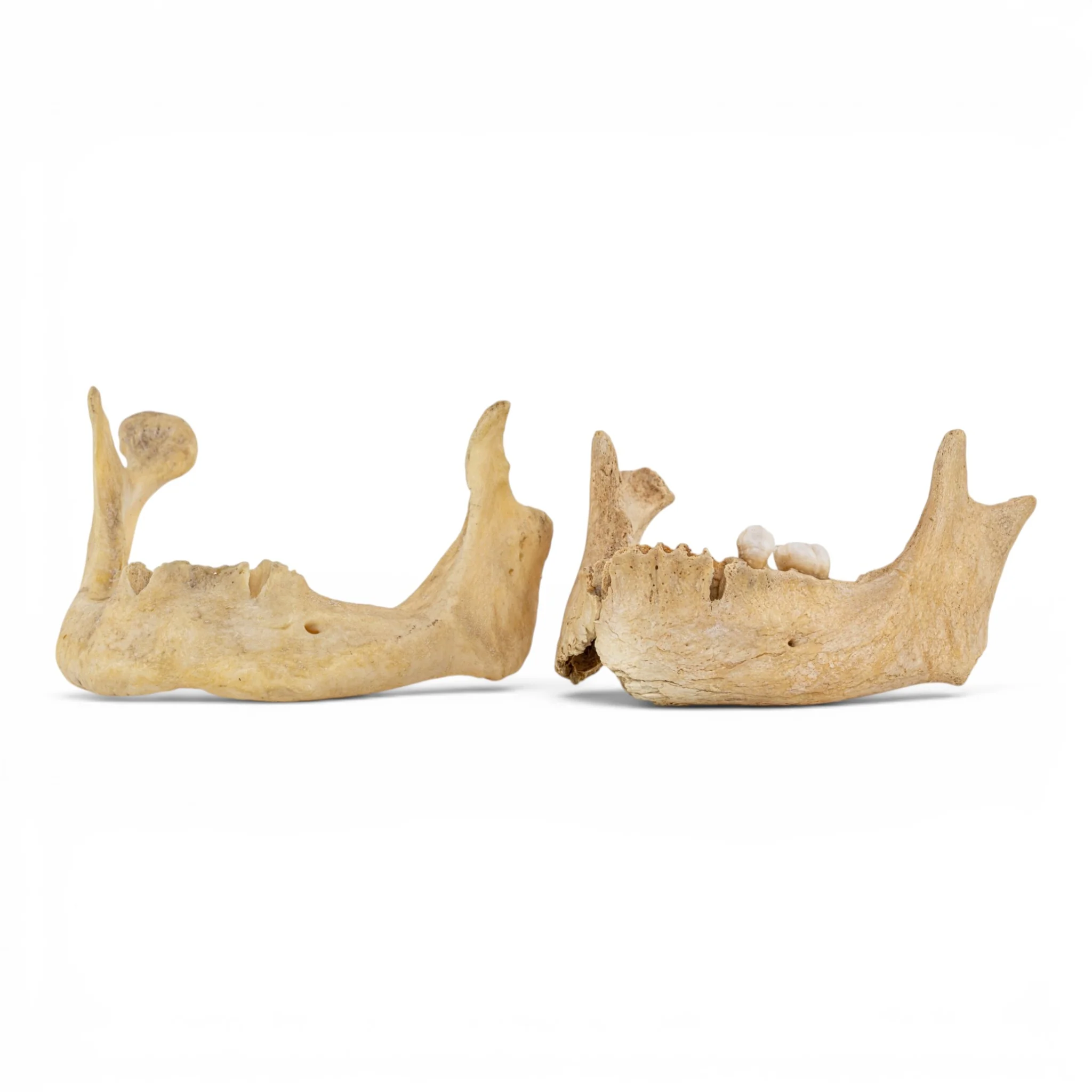 Real Human Mandible - Pathology - Set of 2