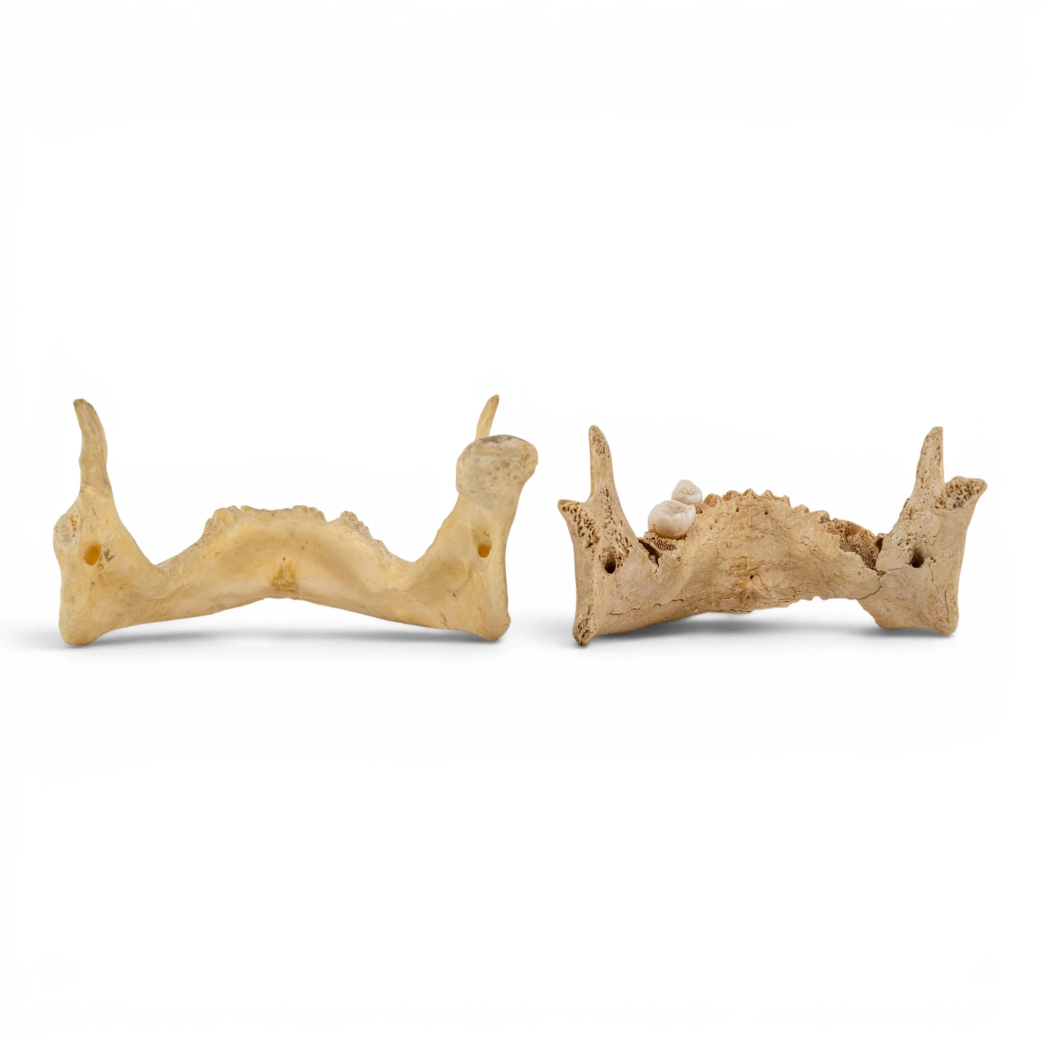 Real Human Mandible - Pathology - Set of 2 - Image 5