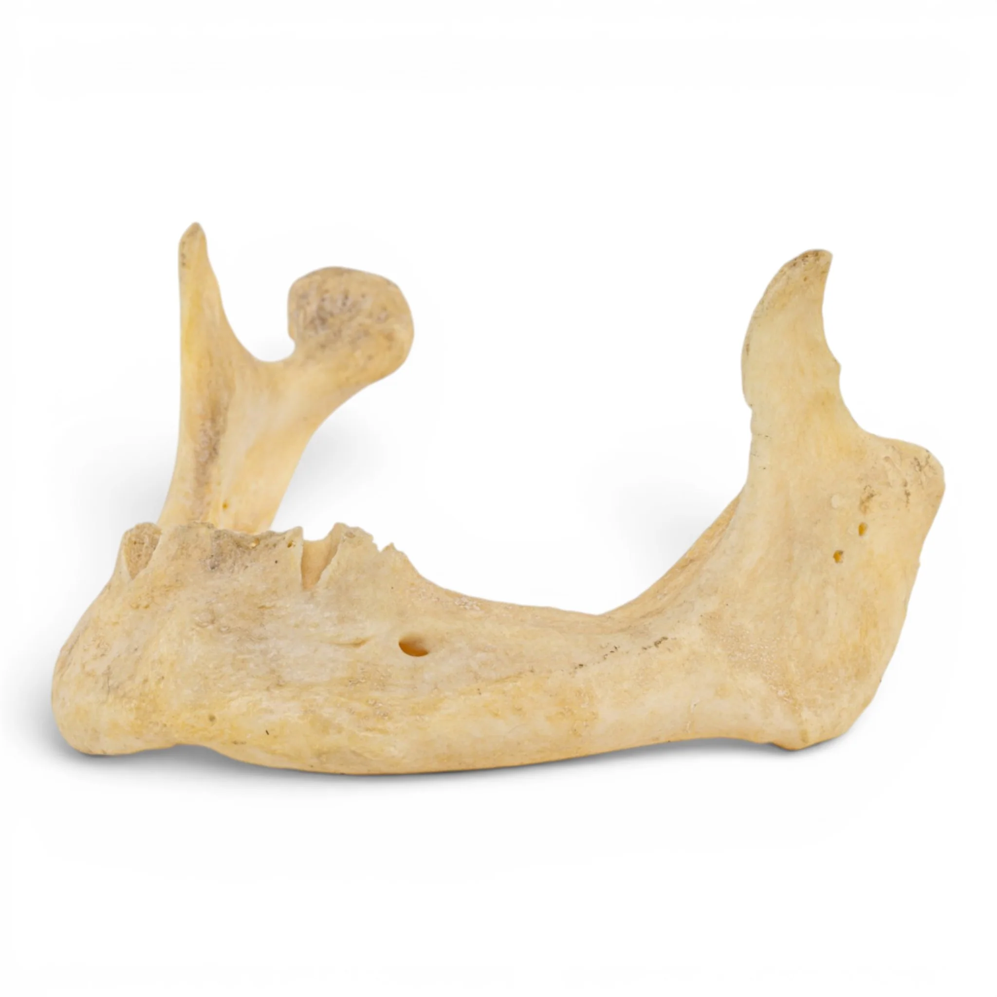 Real Human Mandible - Pathology - Set of 2 - Image 6