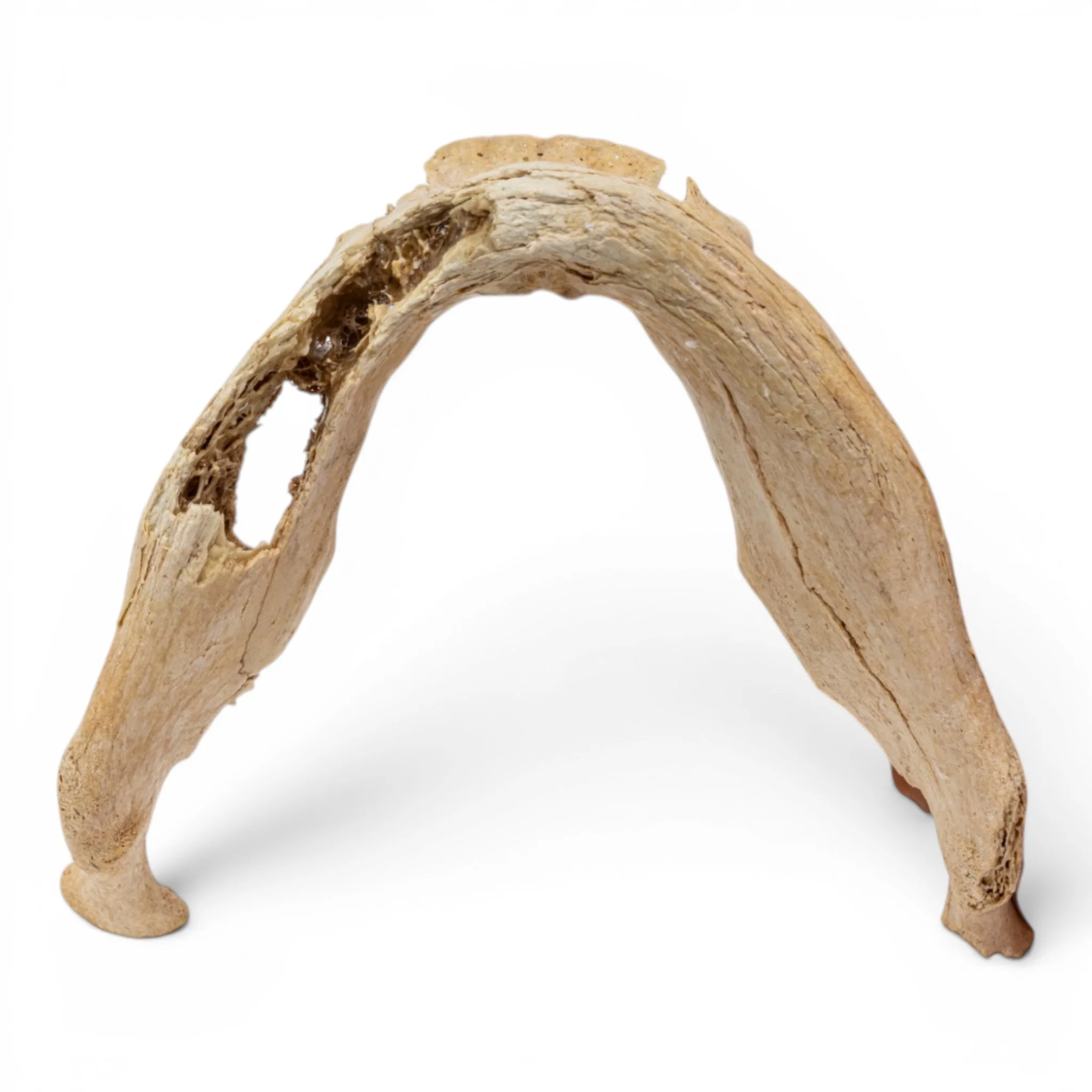 Real Human Mandible - Pathology - Set of 2 - Image 8