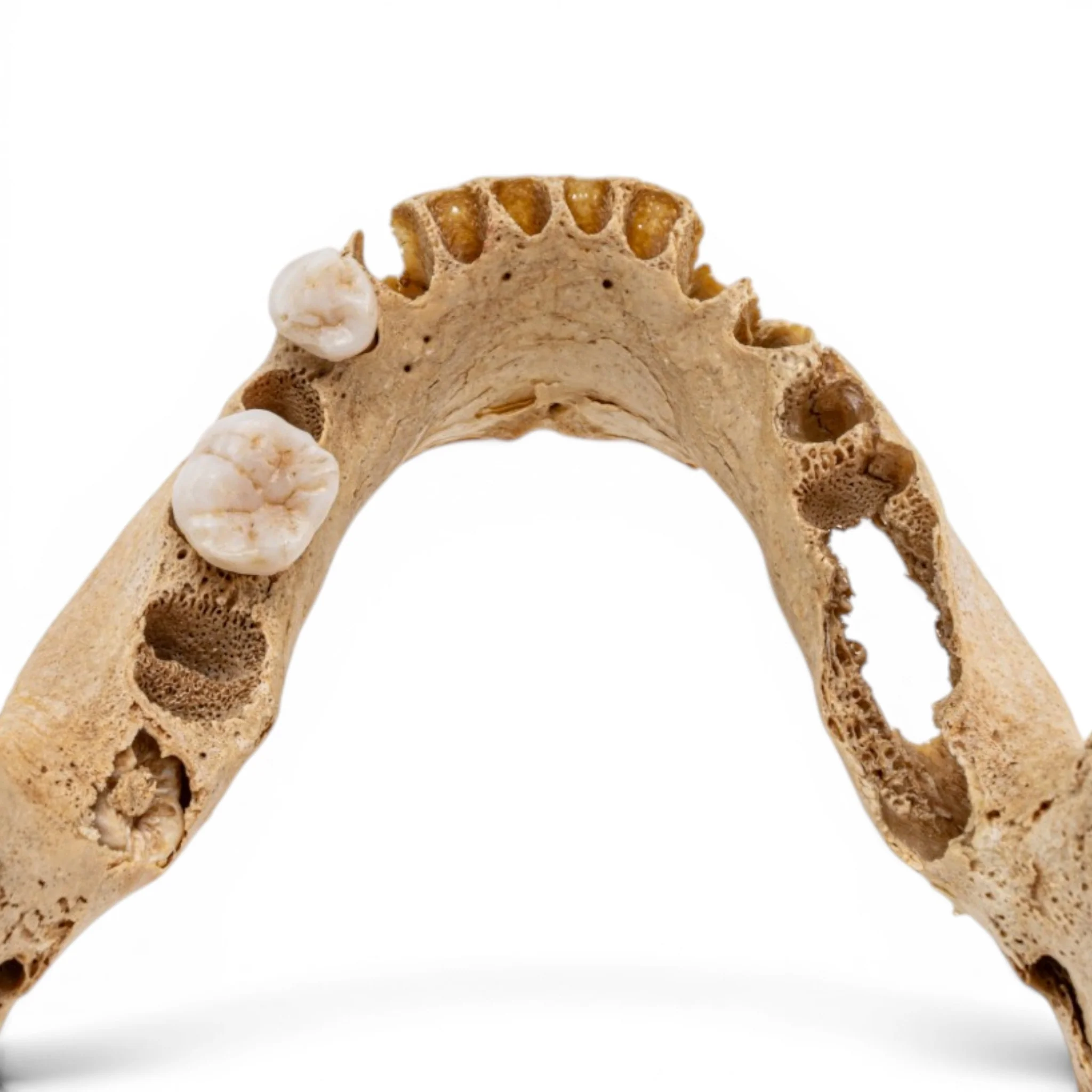 Real Human Mandible - Pathology - Set of 2 - Image 9