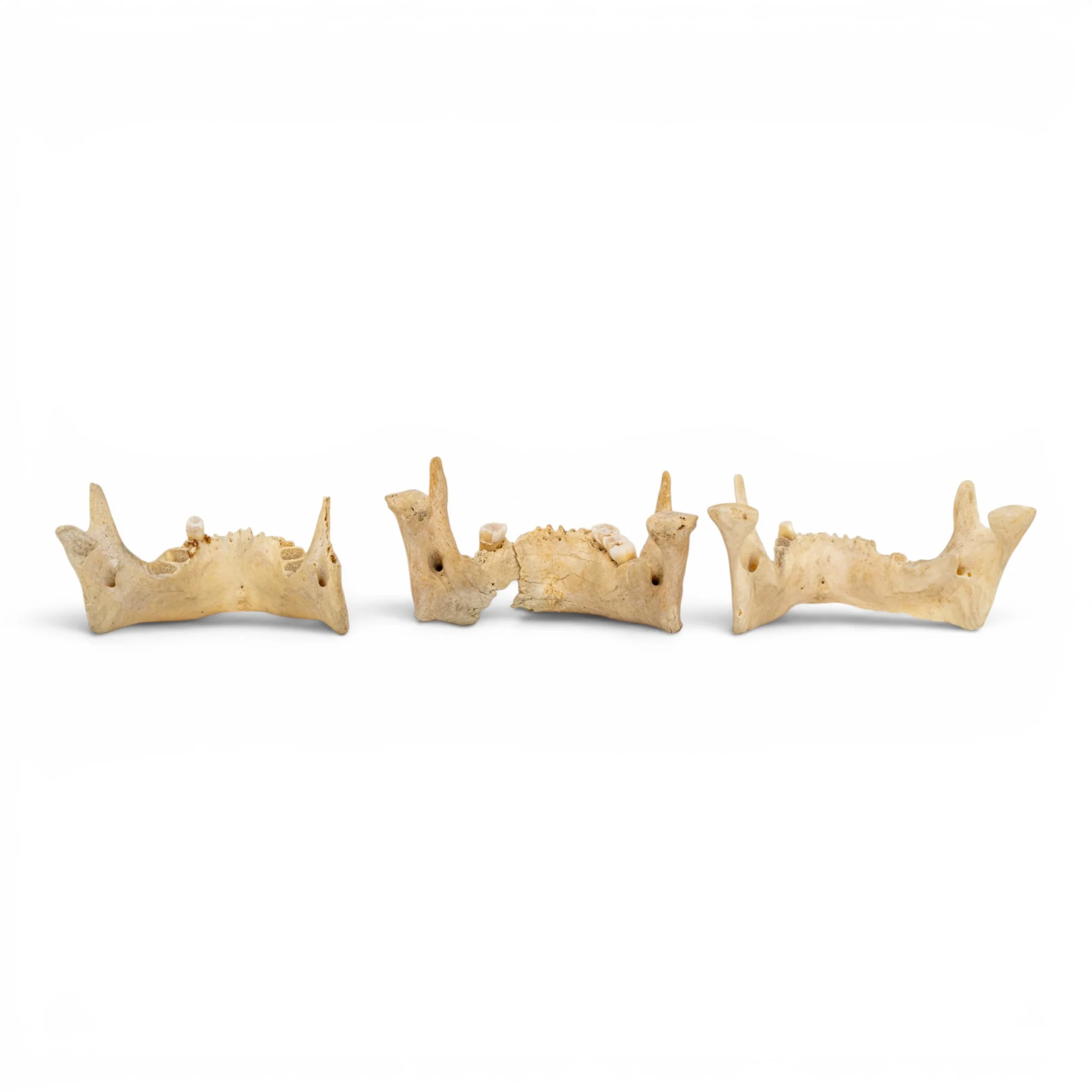 Real Human Mandible - Pathology - Set Of 3 - Image 5