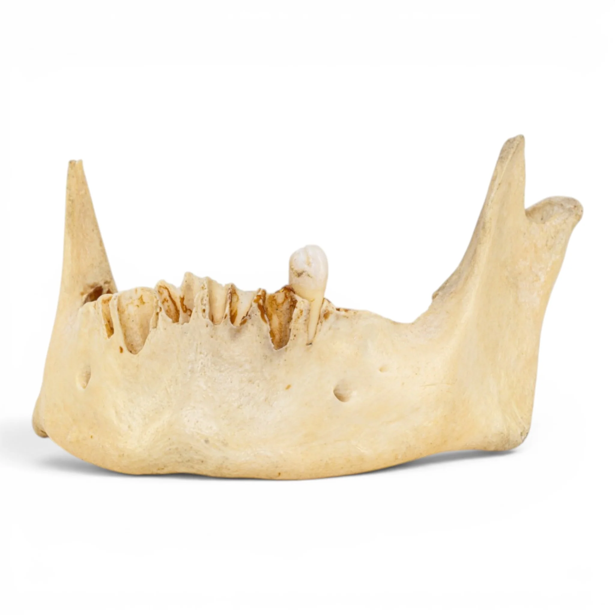 Real Human Mandible - Pathology - Set Of 3 - Image 6