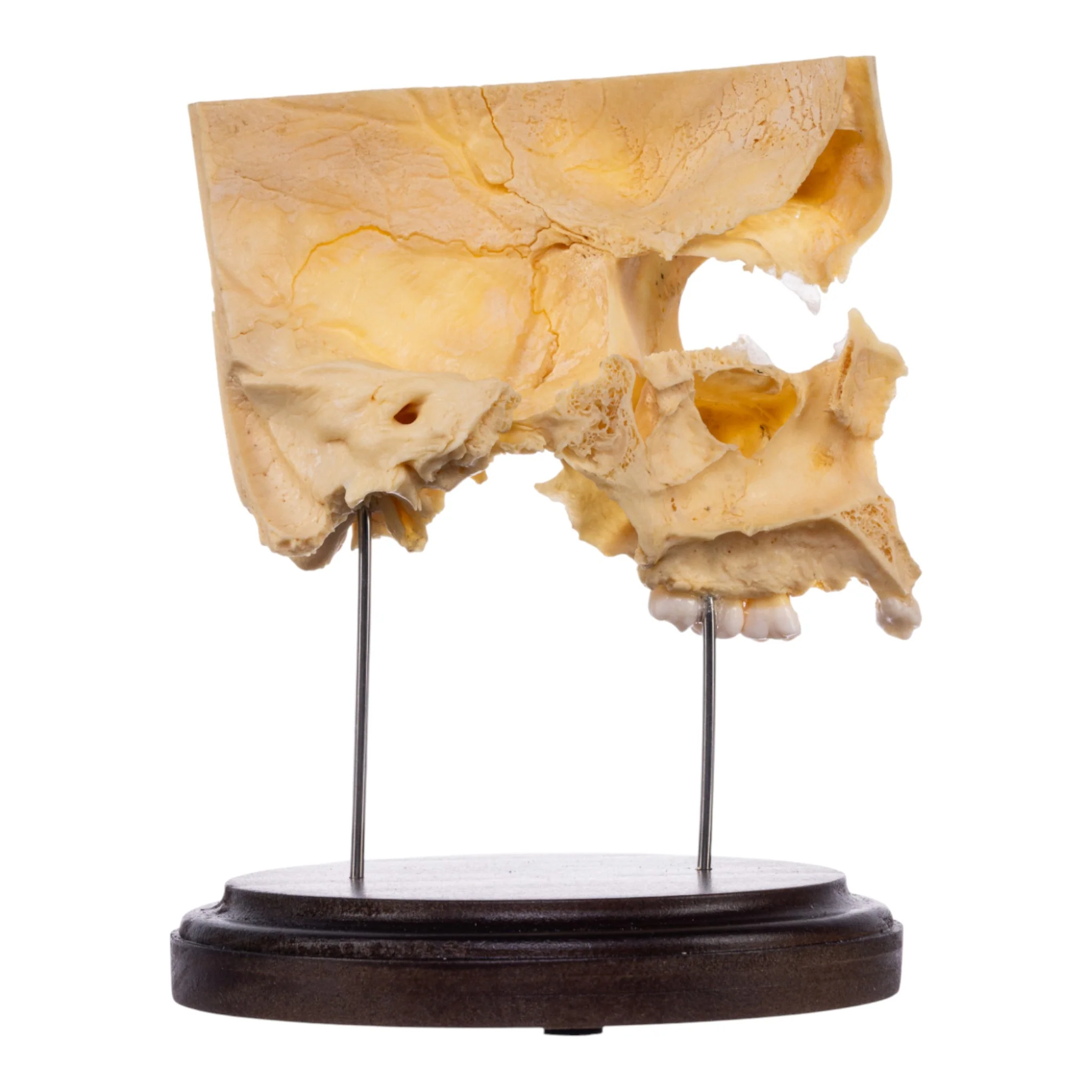 Real Human Partial Skull on Stand - Image 2