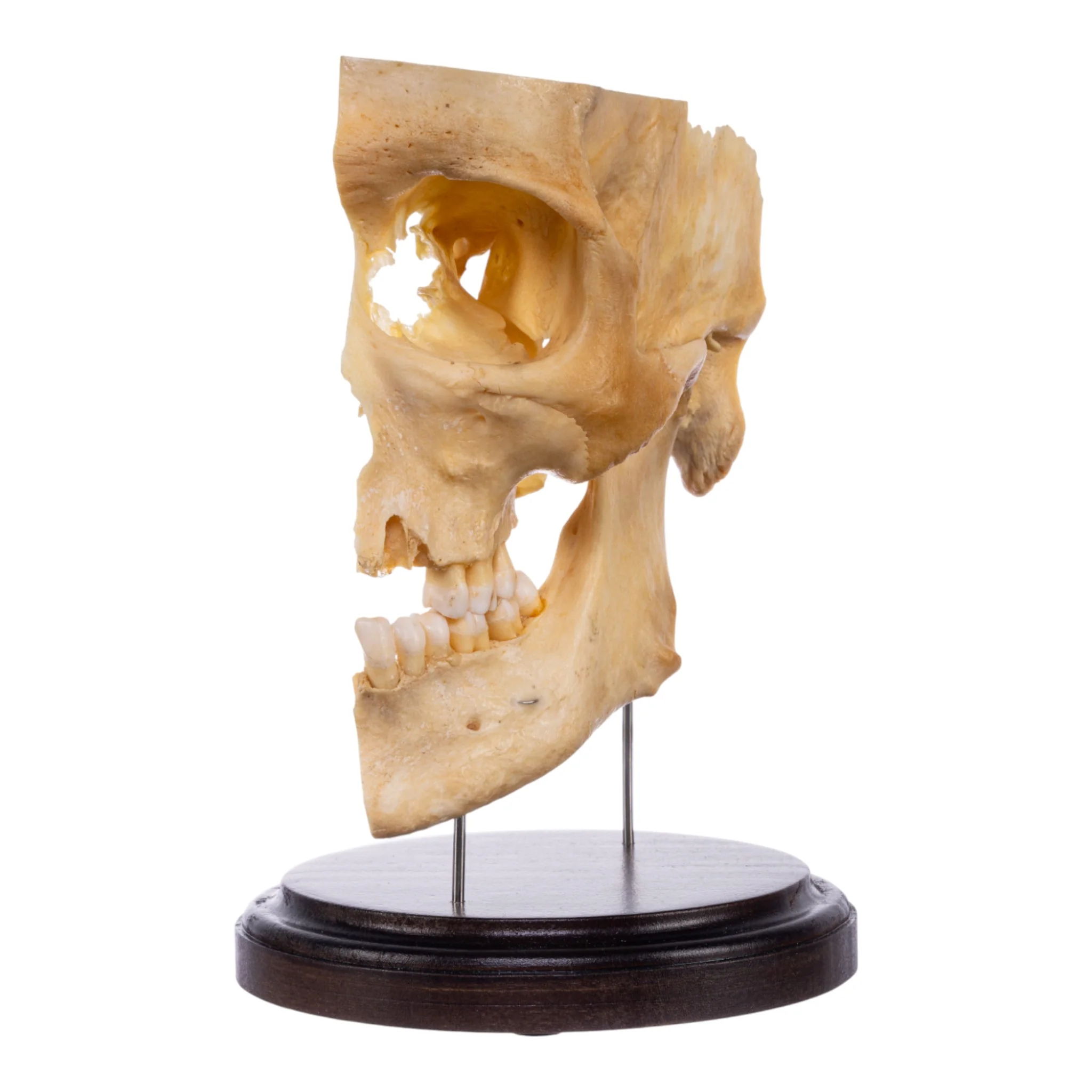 Real Human Partial Skull on Stand