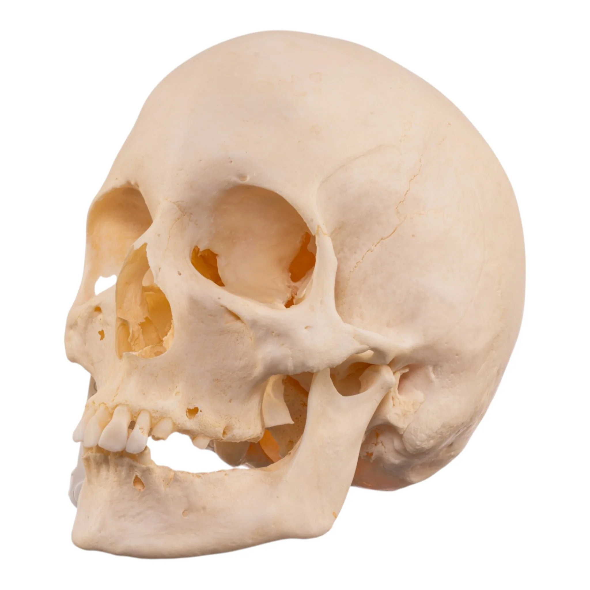 Real Research Quality Human Skull - Pathology