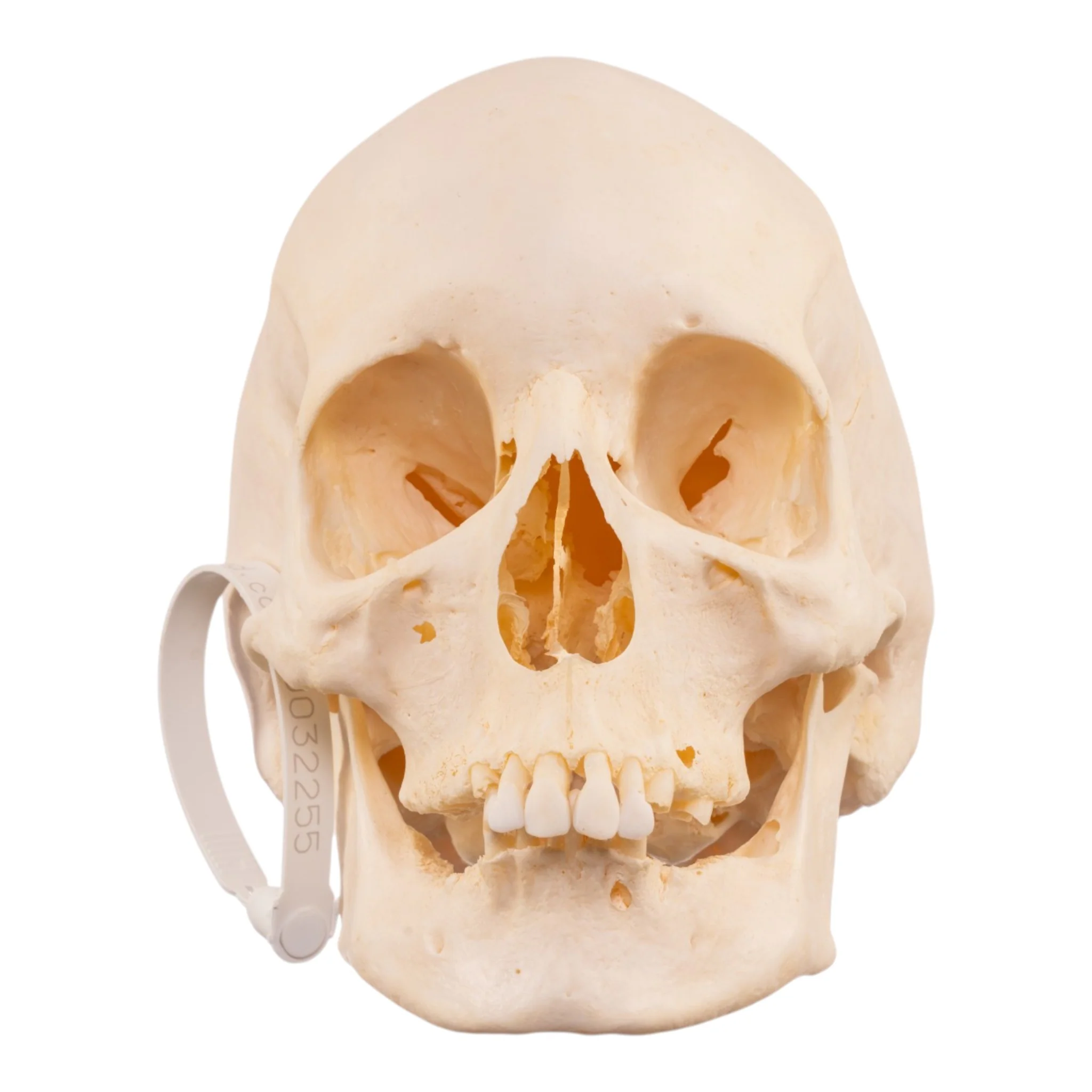 Real Research Quality Human Skull - Pathology - Image 3