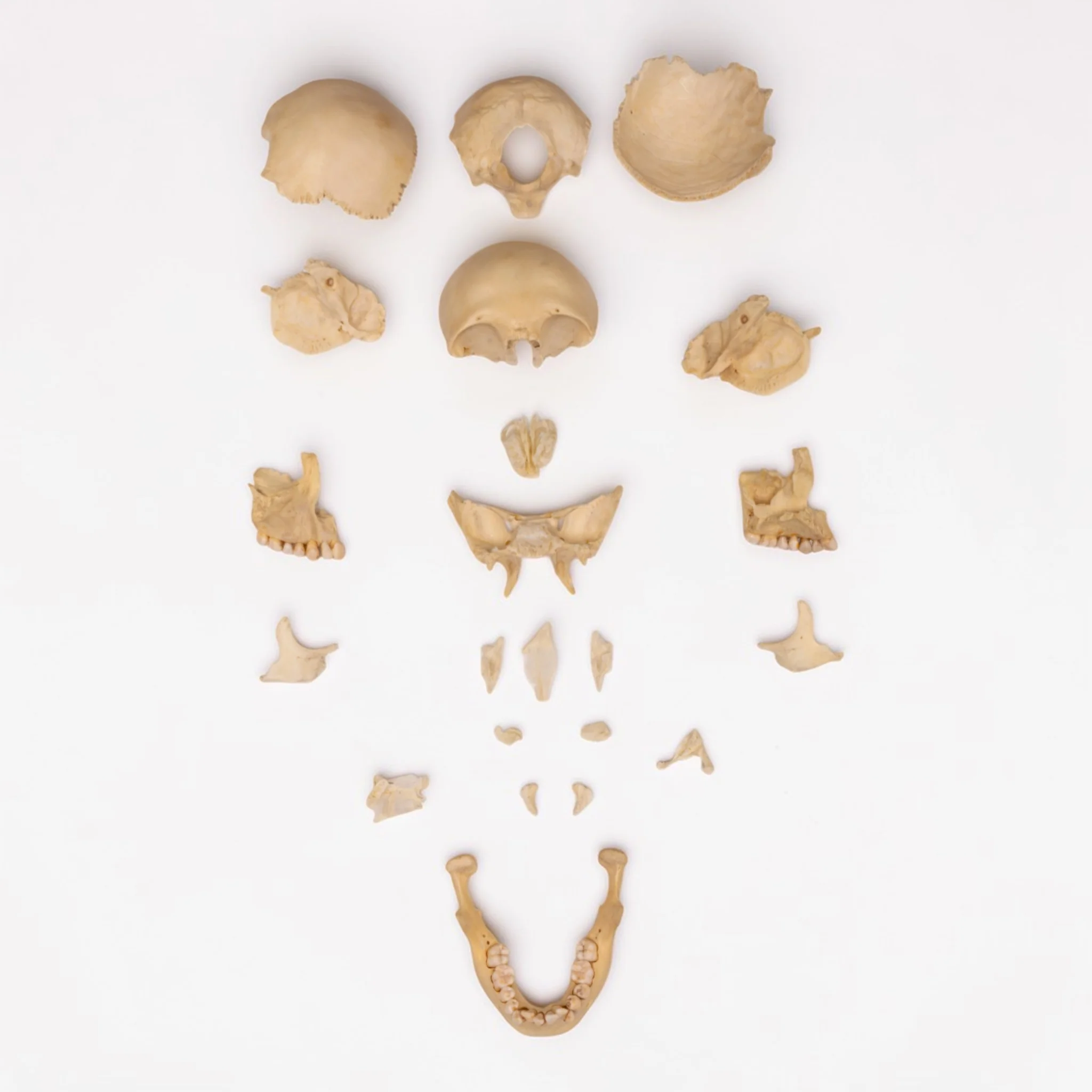 Real Human Skull Disarticulated with Case - Image 2