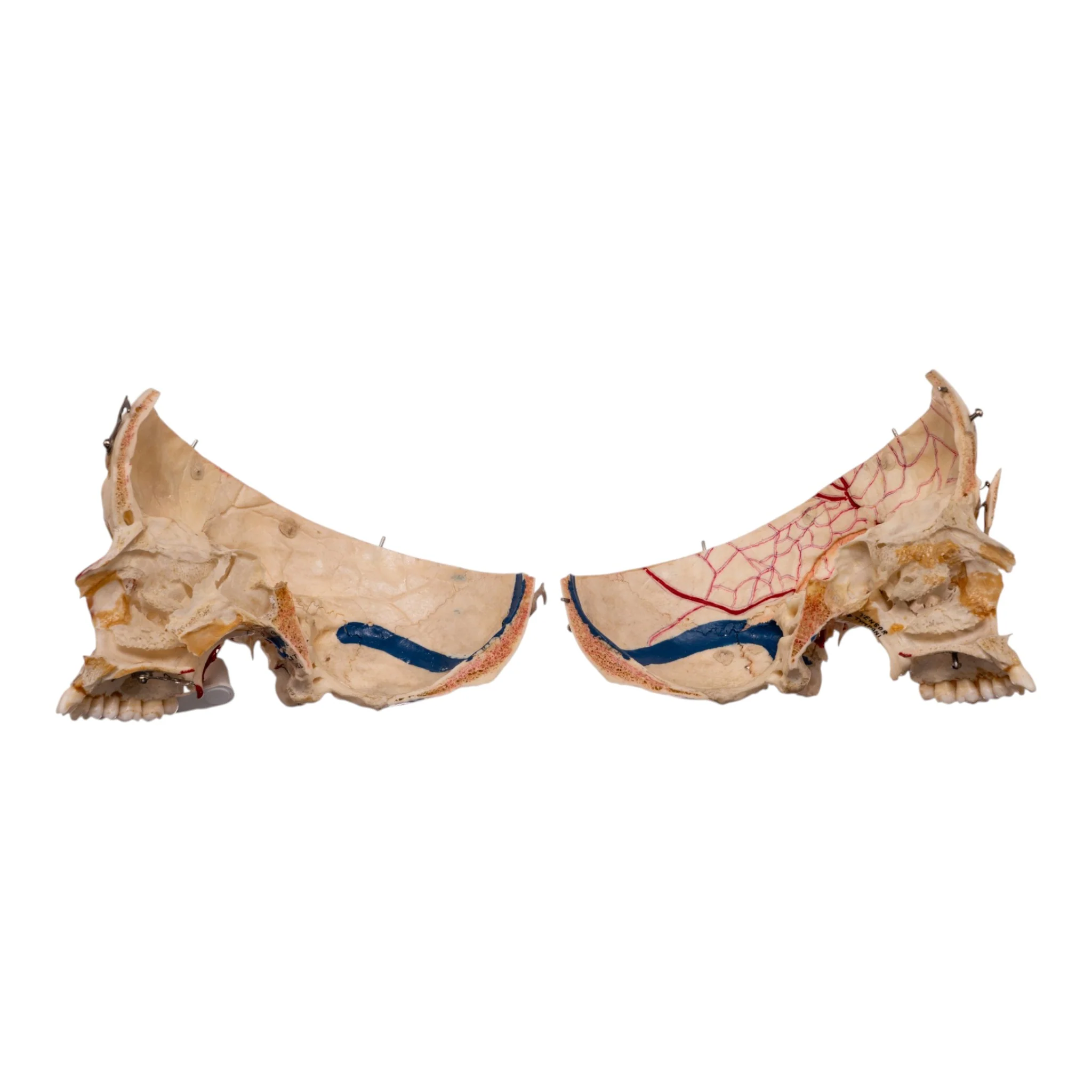 Real Human Dissected Skull in Carrying Case - Image 10
