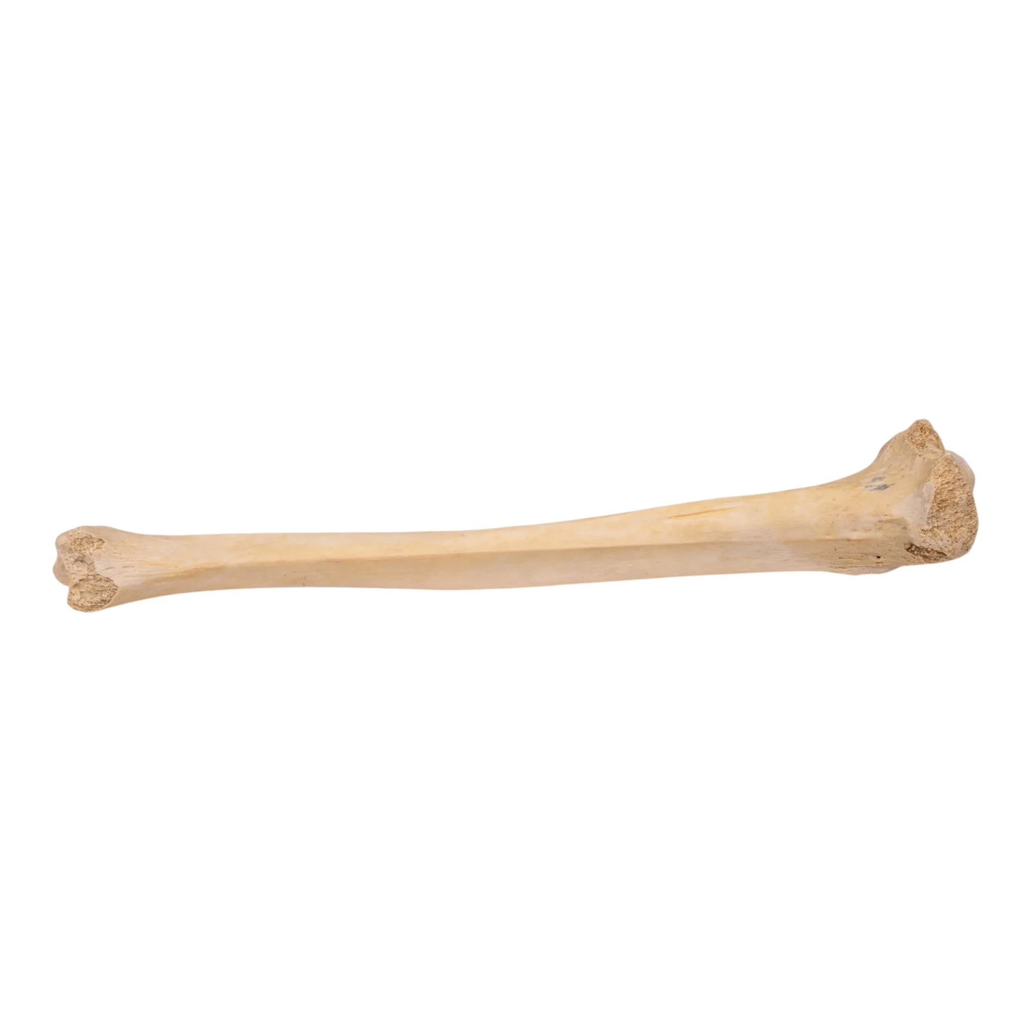Real Human Tibia - Pathology - Image 2