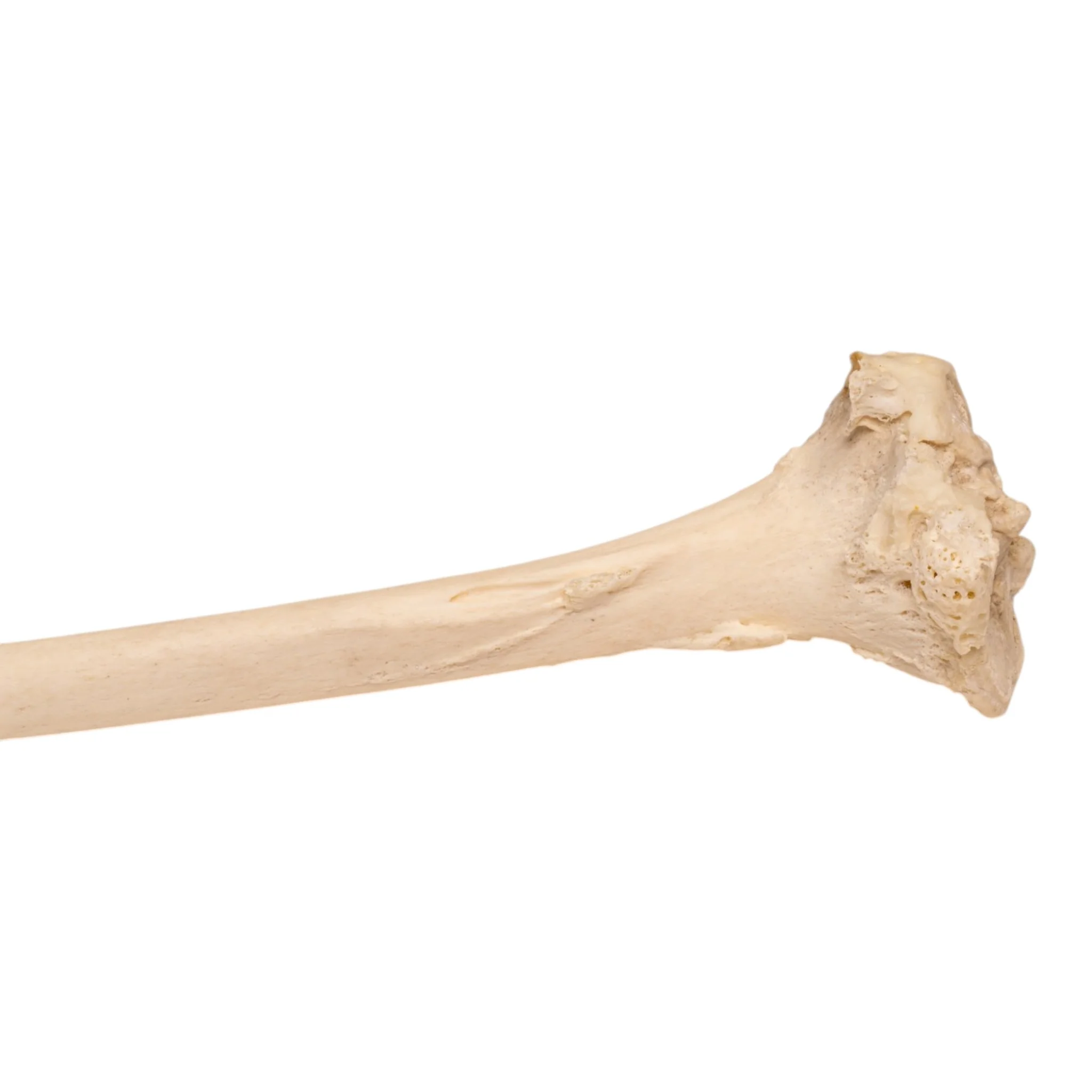 Real Human Left Tibia - Pathology - Image 4