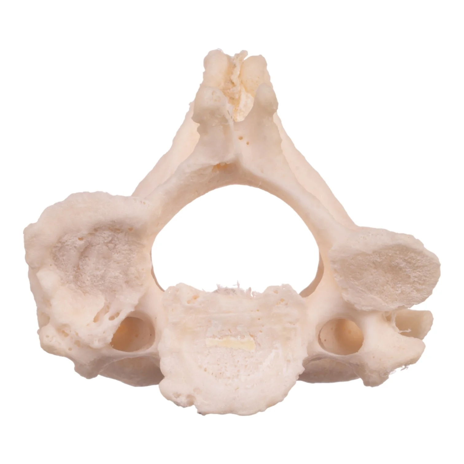 Real Research Quality Human Cervical and Axis Vertebrae - Fused - Image 5