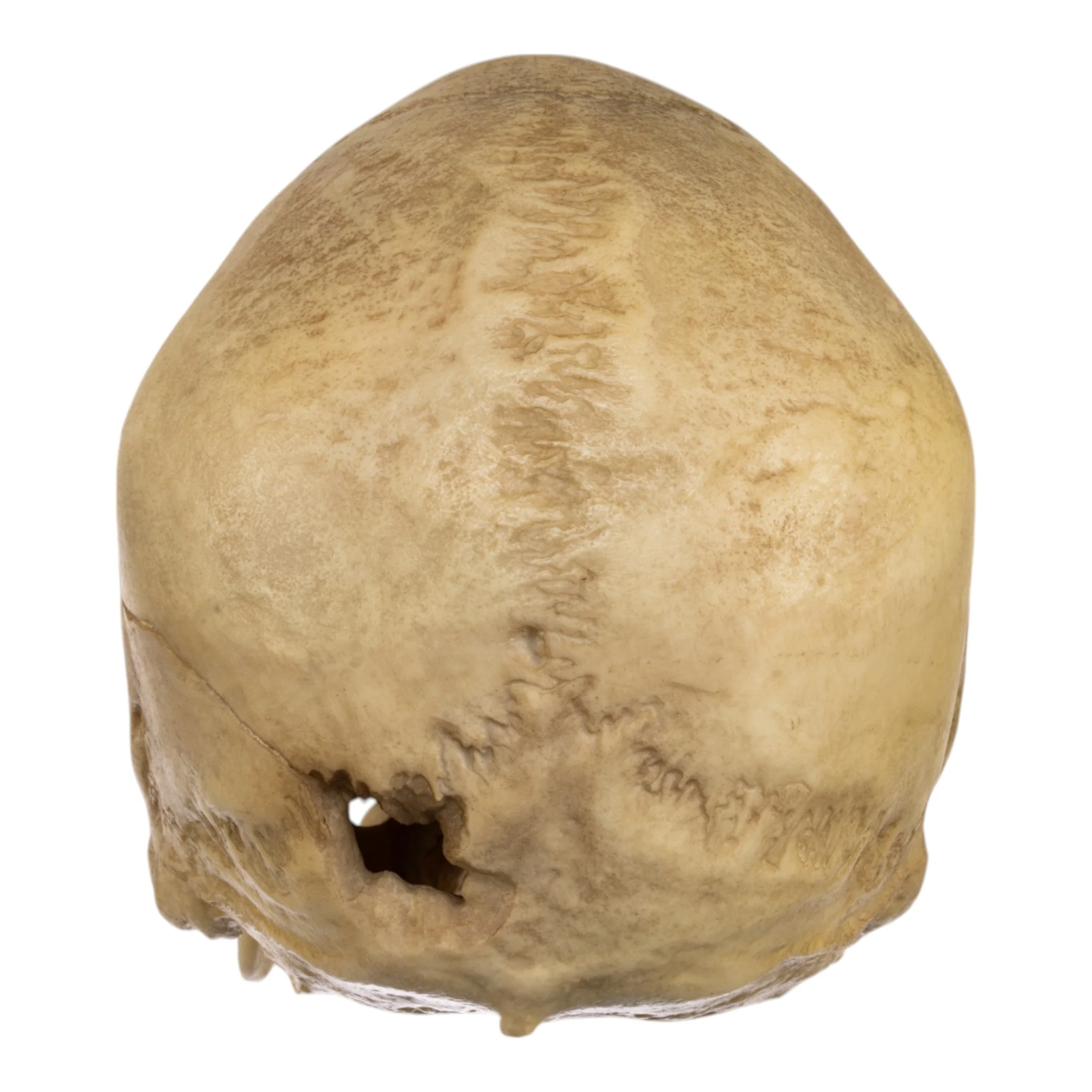 Replica Human Male with a 32-caliber Gunshot Wound Skull - Image 5