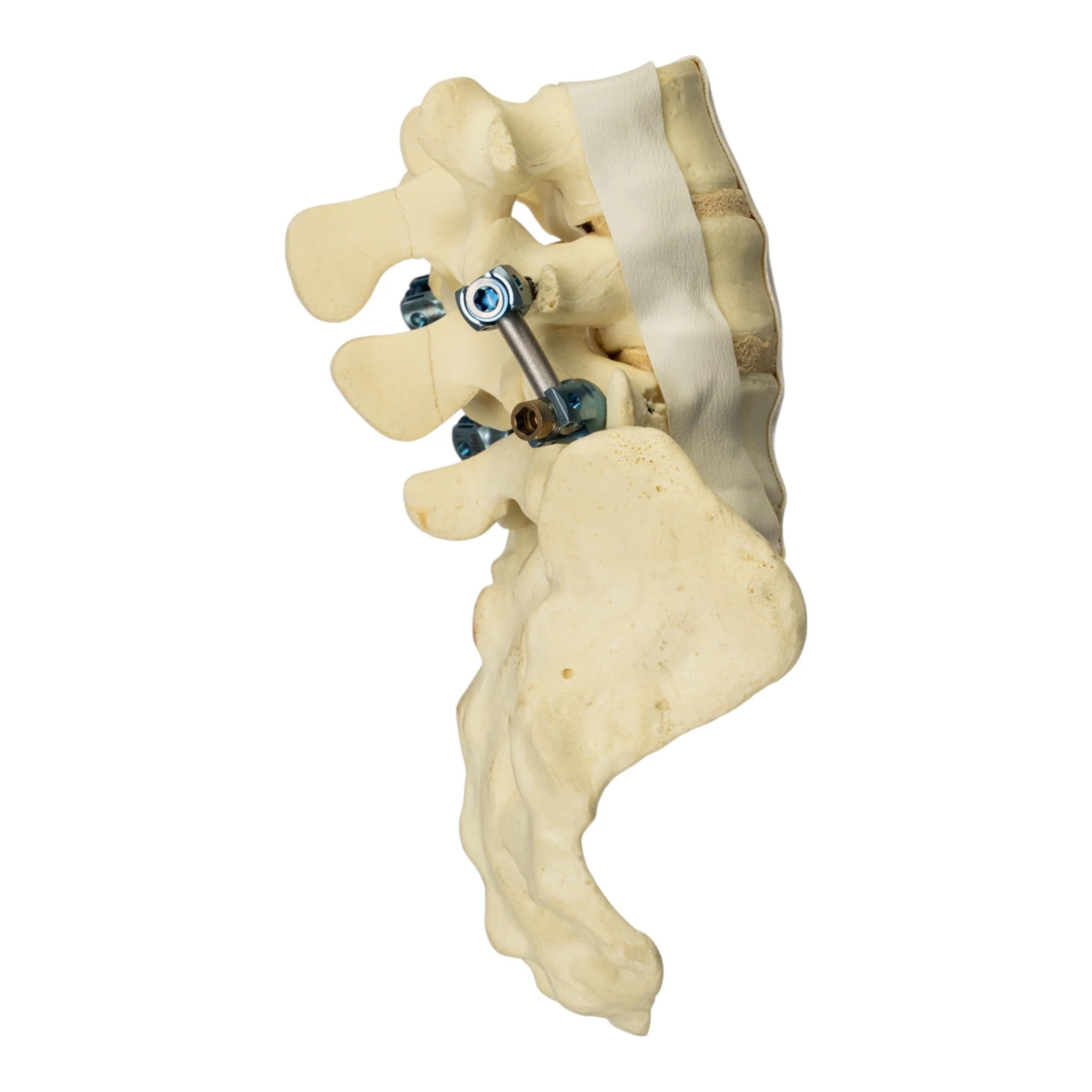 Replica Human Sacrum & Lumbar Model with Hardware - Image 2