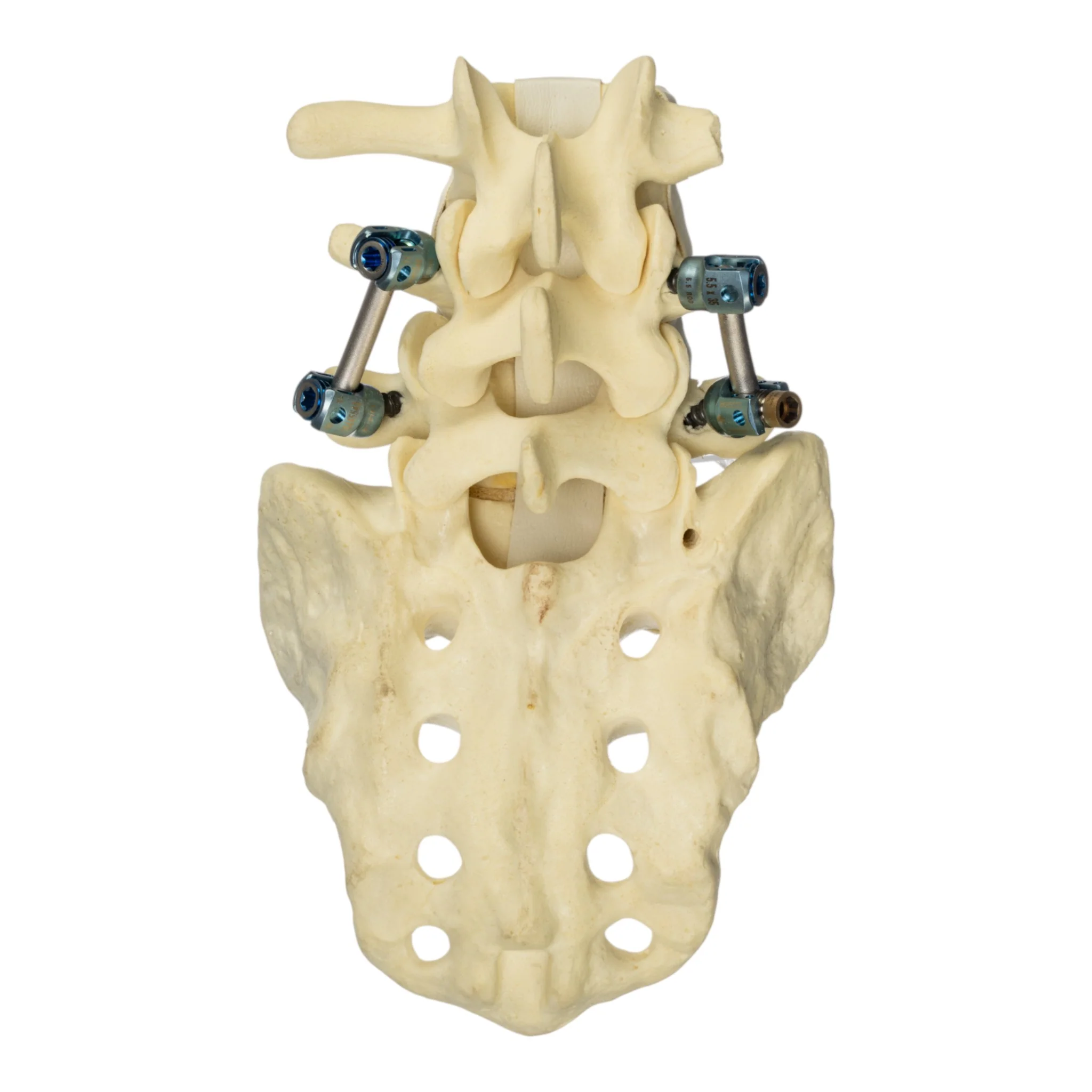 Replica Human Sacrum & Lumbar Model with Hardware - Image 3