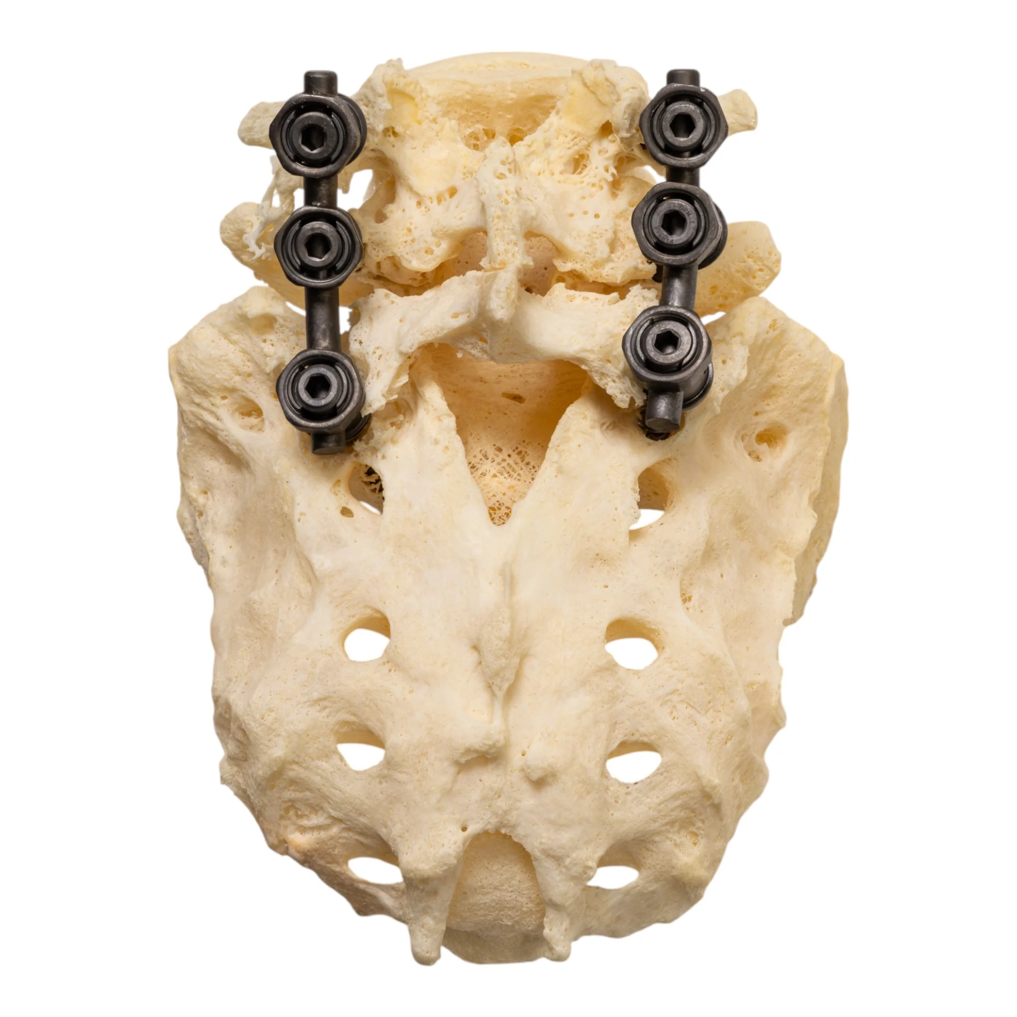 Real Research Quality Human Skeleton - Disarticulated (Pathology) - Image 10