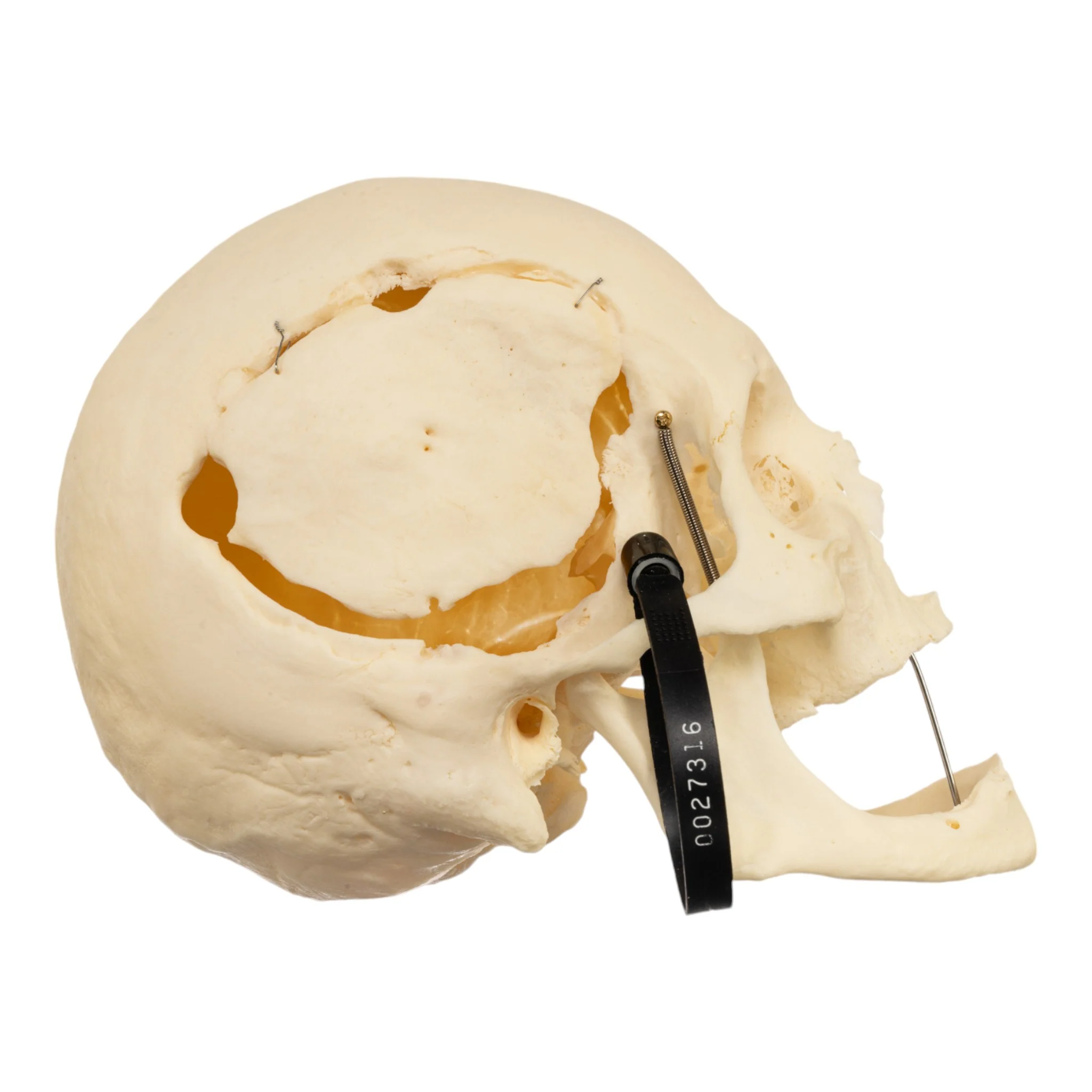Real Research Quality Human Skeleton - Disarticulated (Pathology) - Image 3