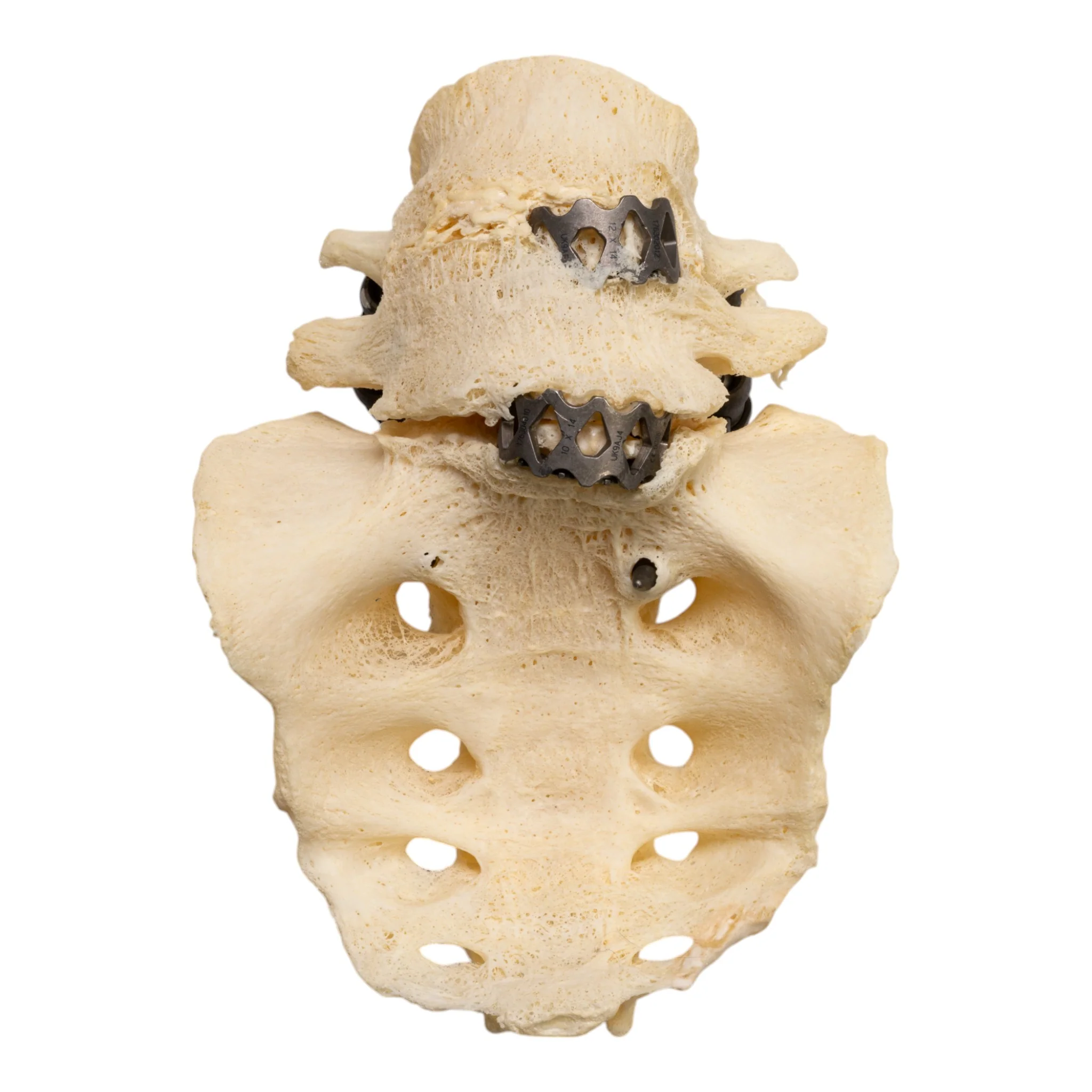 Real Research Quality Human Skeleton - Disarticulated (Pathology) - Image 9